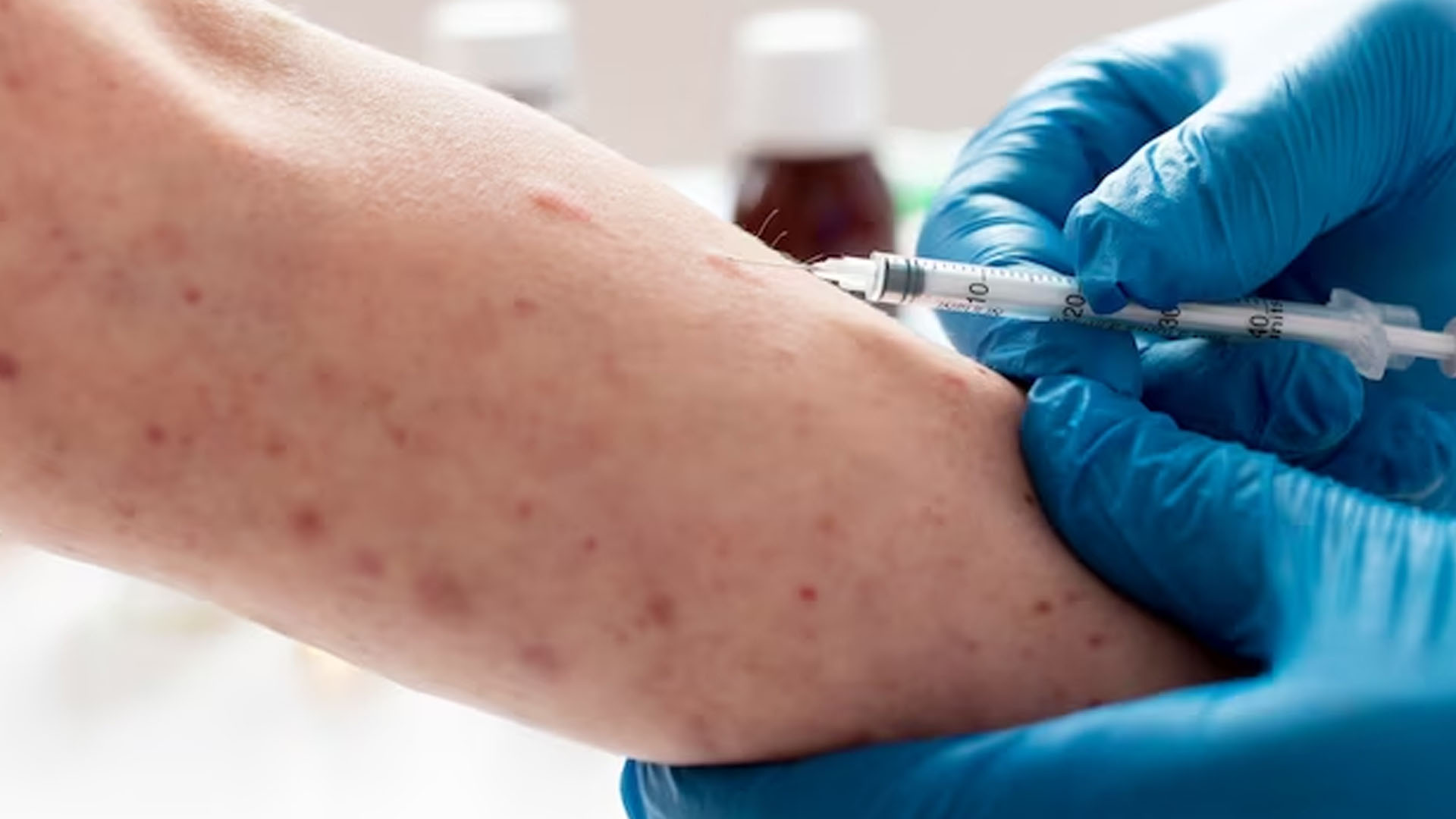 what-are-the-signs-and-symptoms-of-smallpox-nutritionfact-in