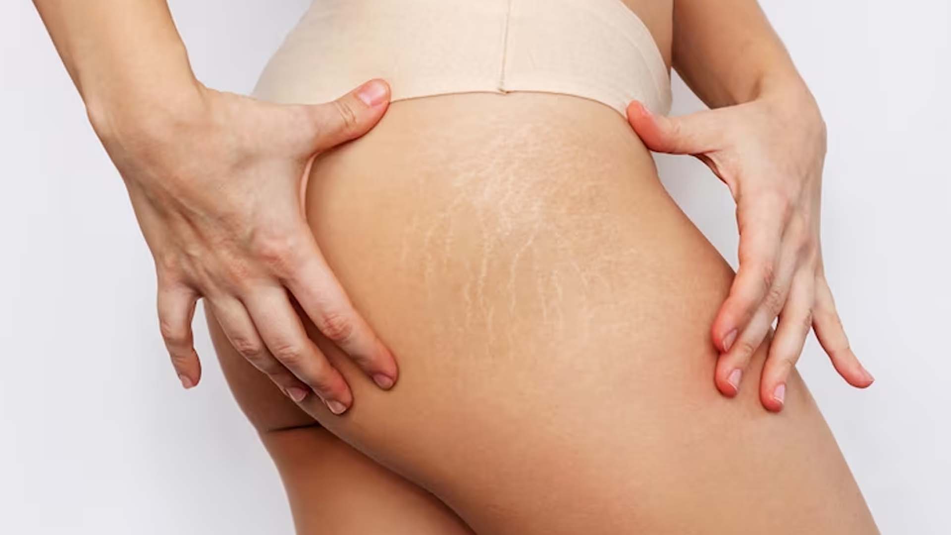 Women showing her Stretch Marks on Buttocks