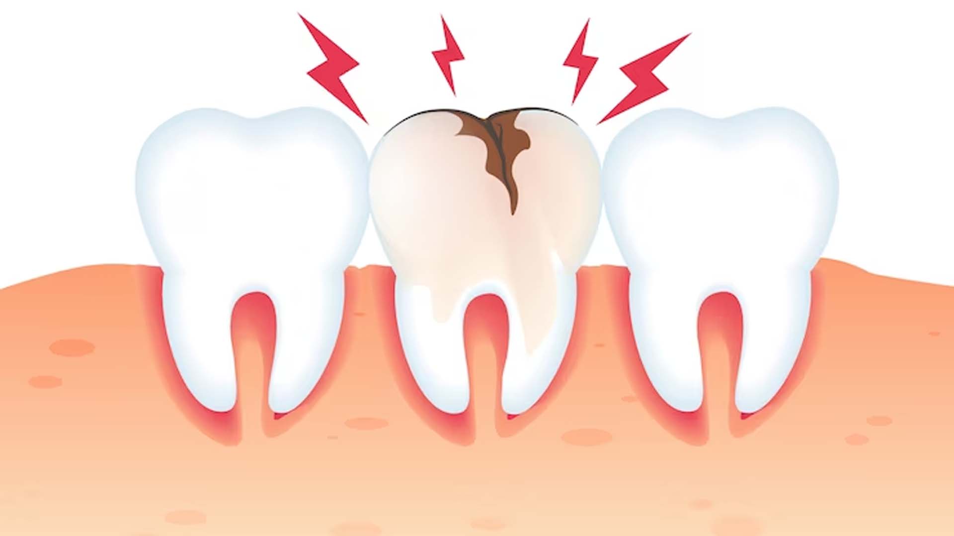Cavities