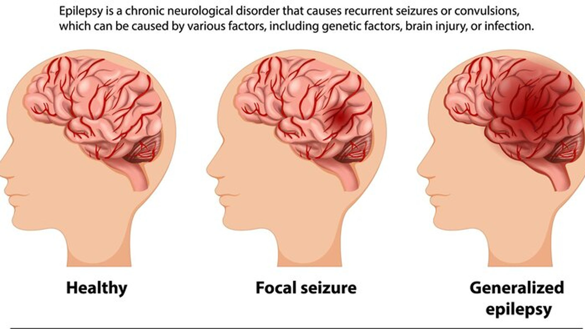 What are the Symptoms of Temporal Lobe Epilepsy?