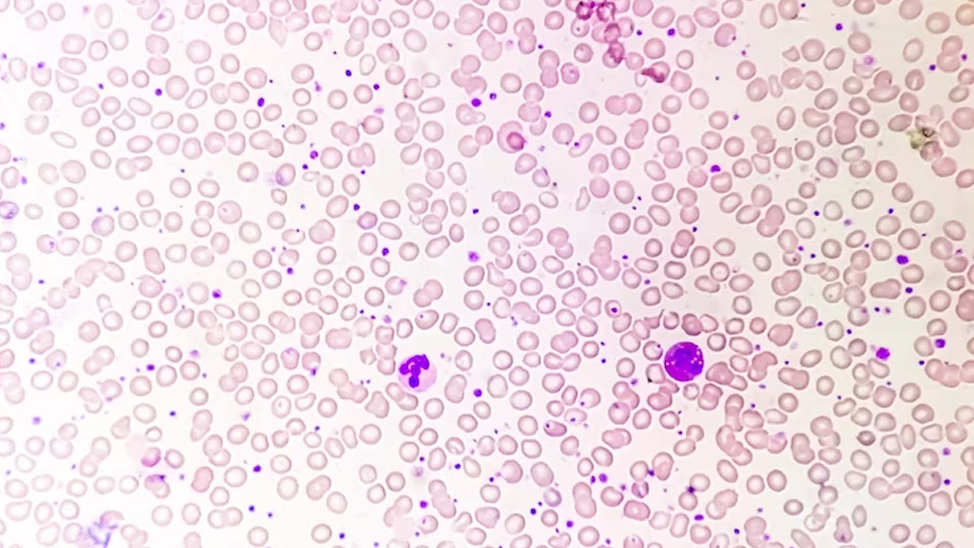 High platelet count