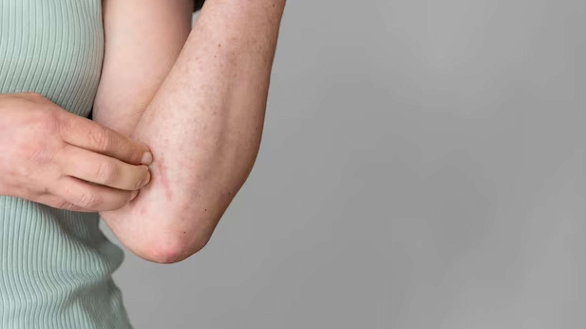 What are the Symptoms of Tinea?