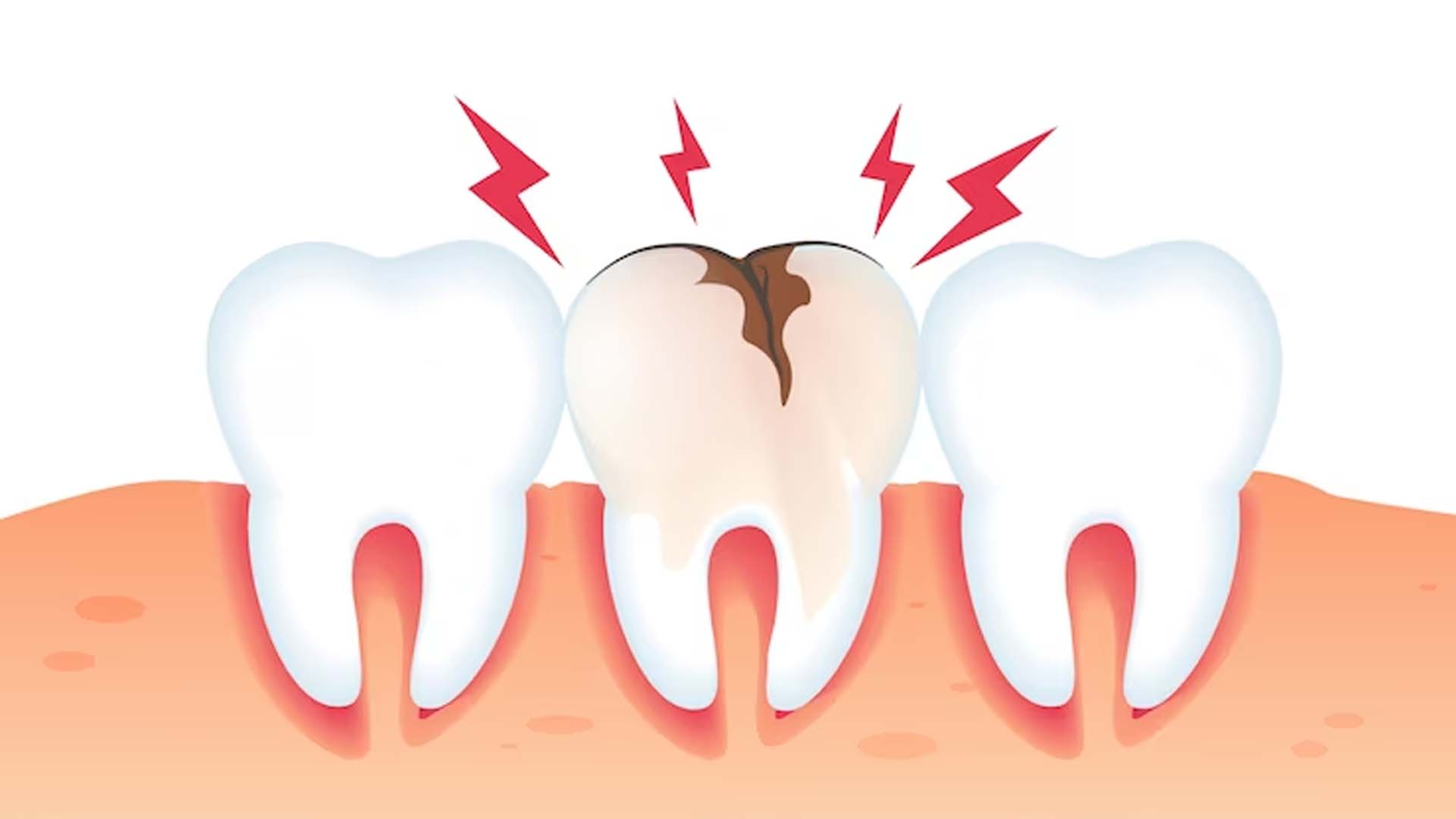 Tooth Decay or dental caries or cavities