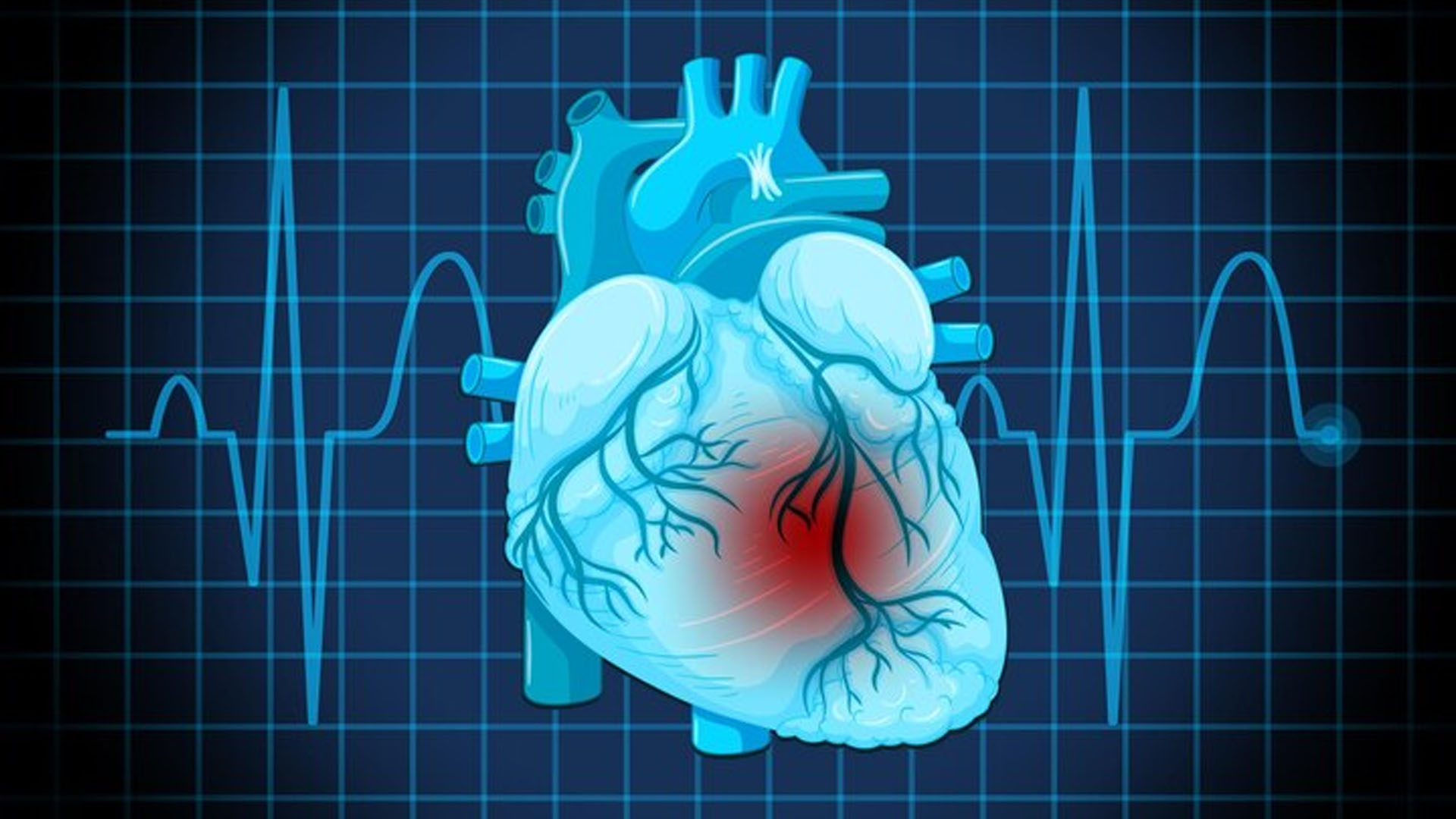 Is Tachycardia a Symptom of Heart Failure?