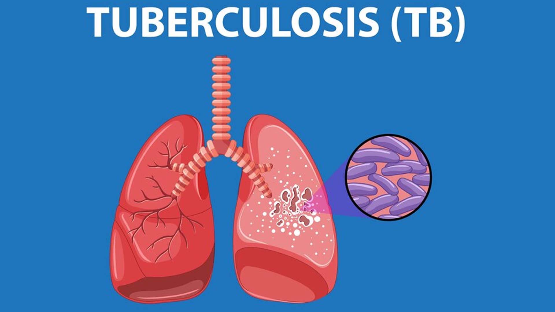 Tuberculosis (TB