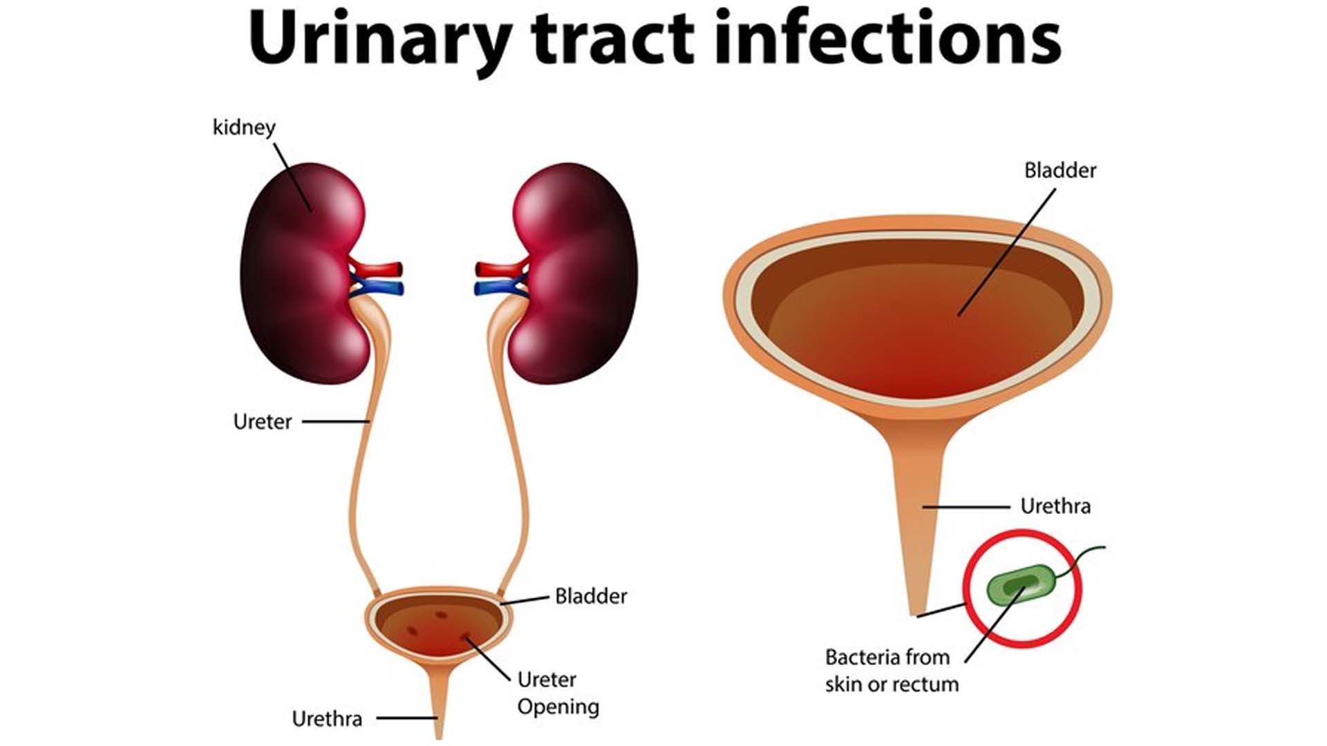 Urinary Tract Infection (UTI)