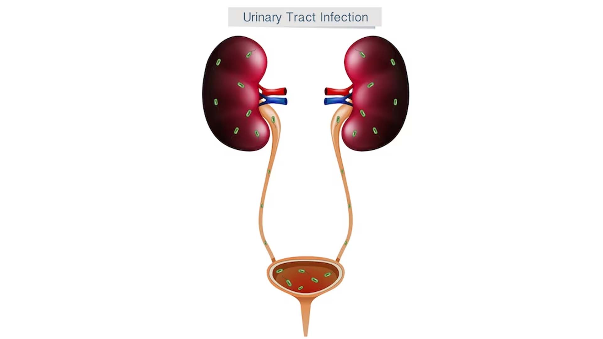 urinary tract infection (UTI)