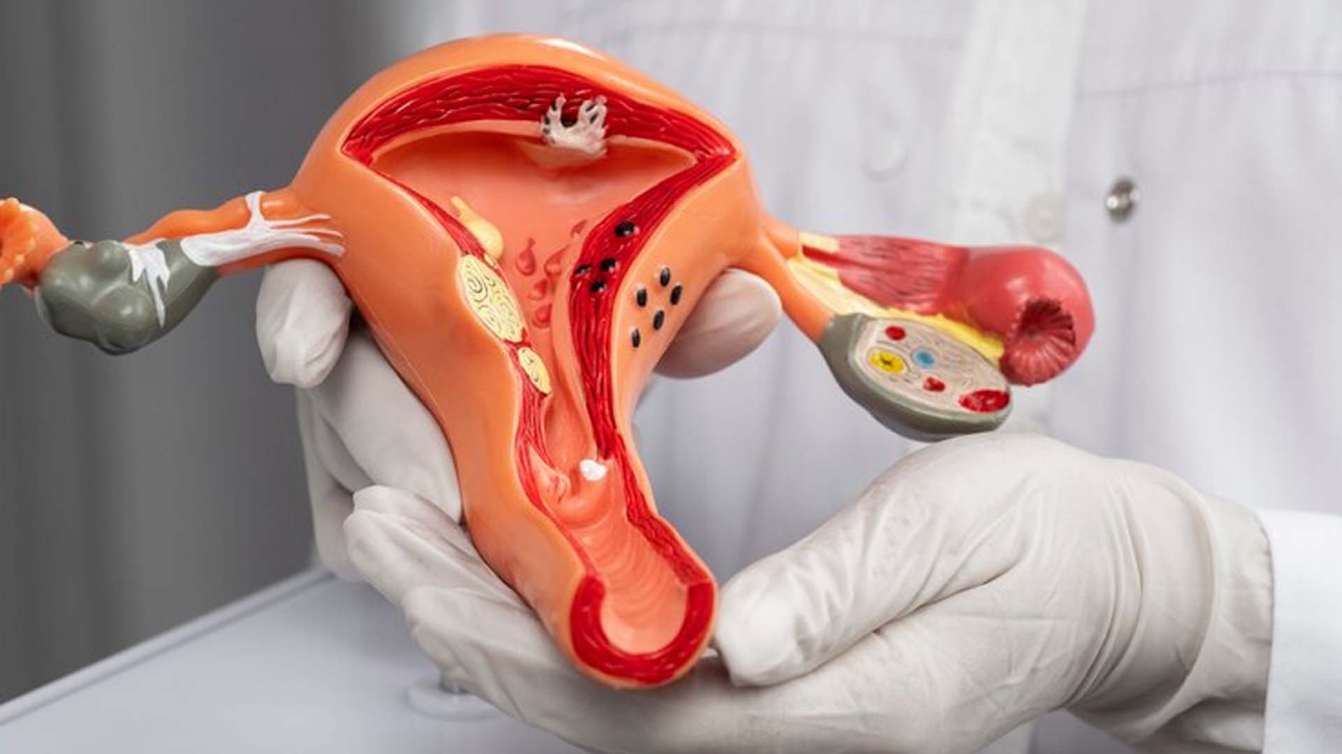 Uterine polyps