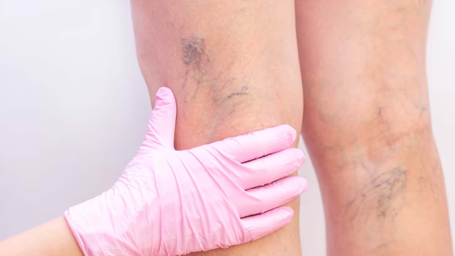 Varicose Veins
