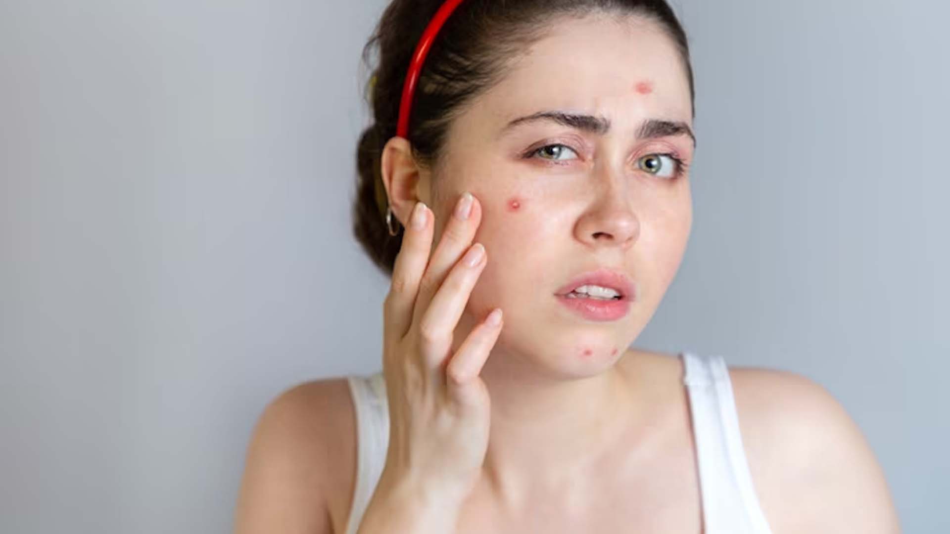 Pimples on Women face
