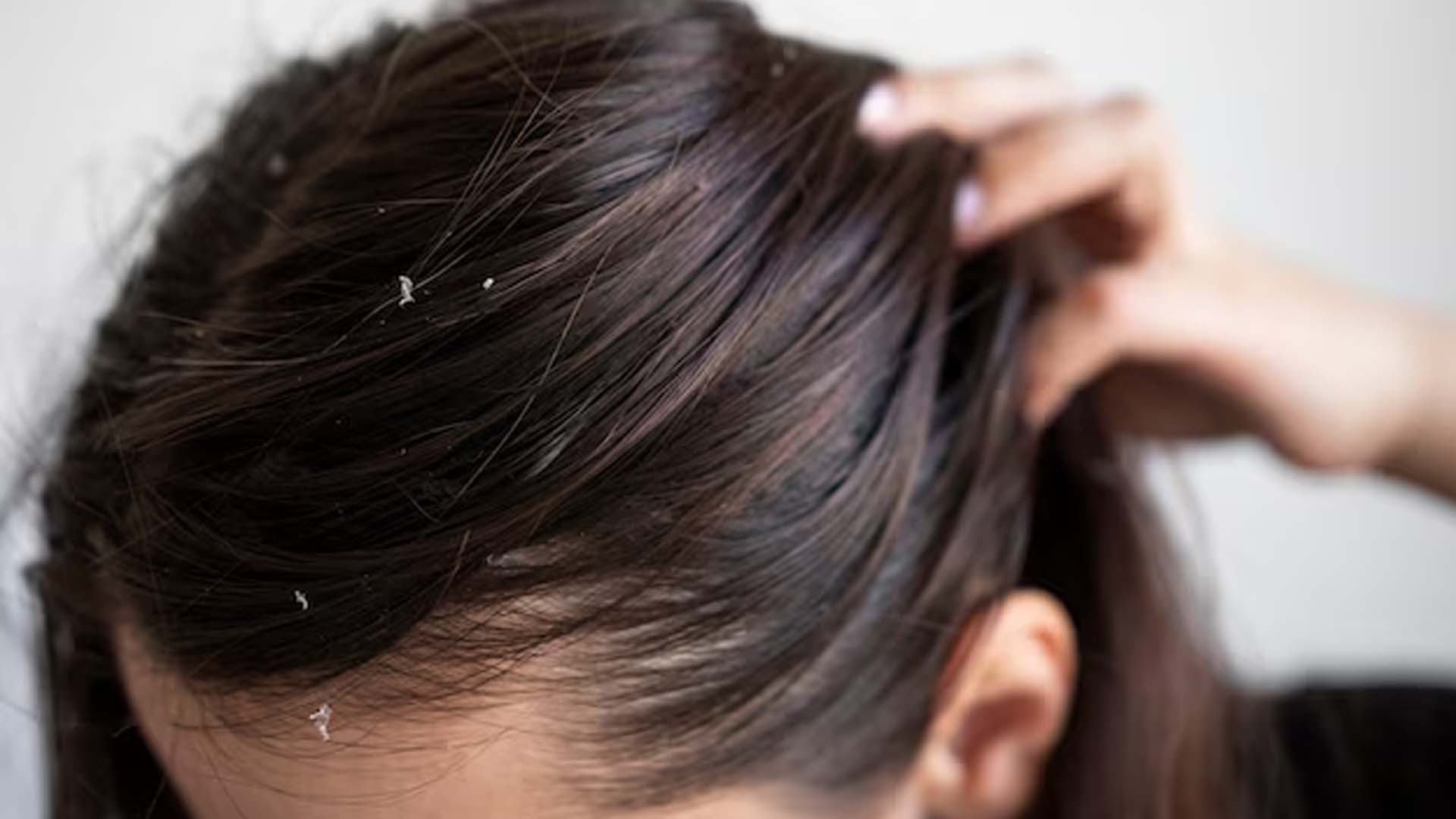 Women Showing Dandruff In her Hair