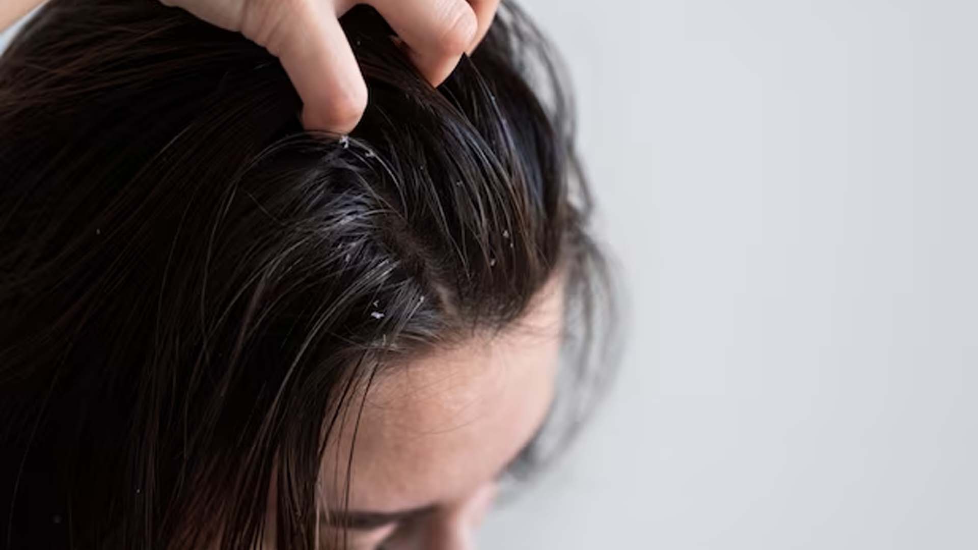 Dandruff in Women's Head