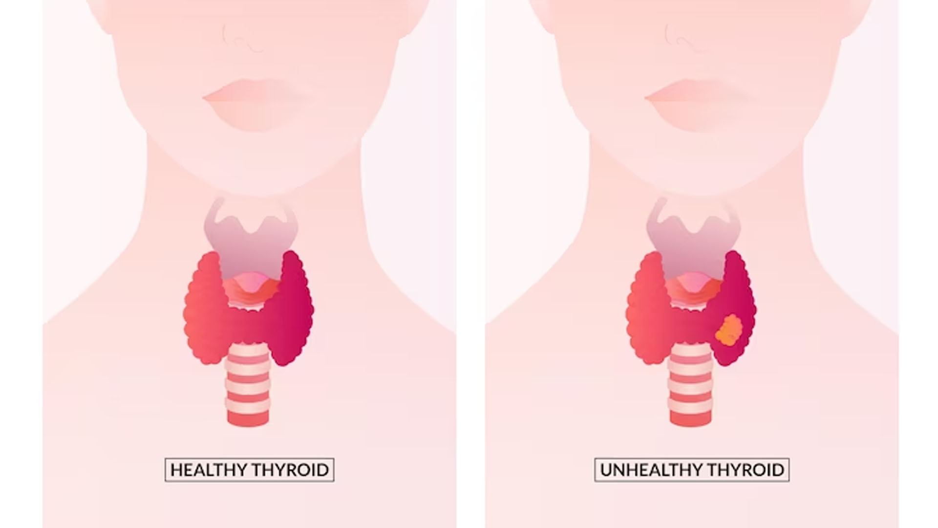 What are the Symptoms of Tonsil Cancer?