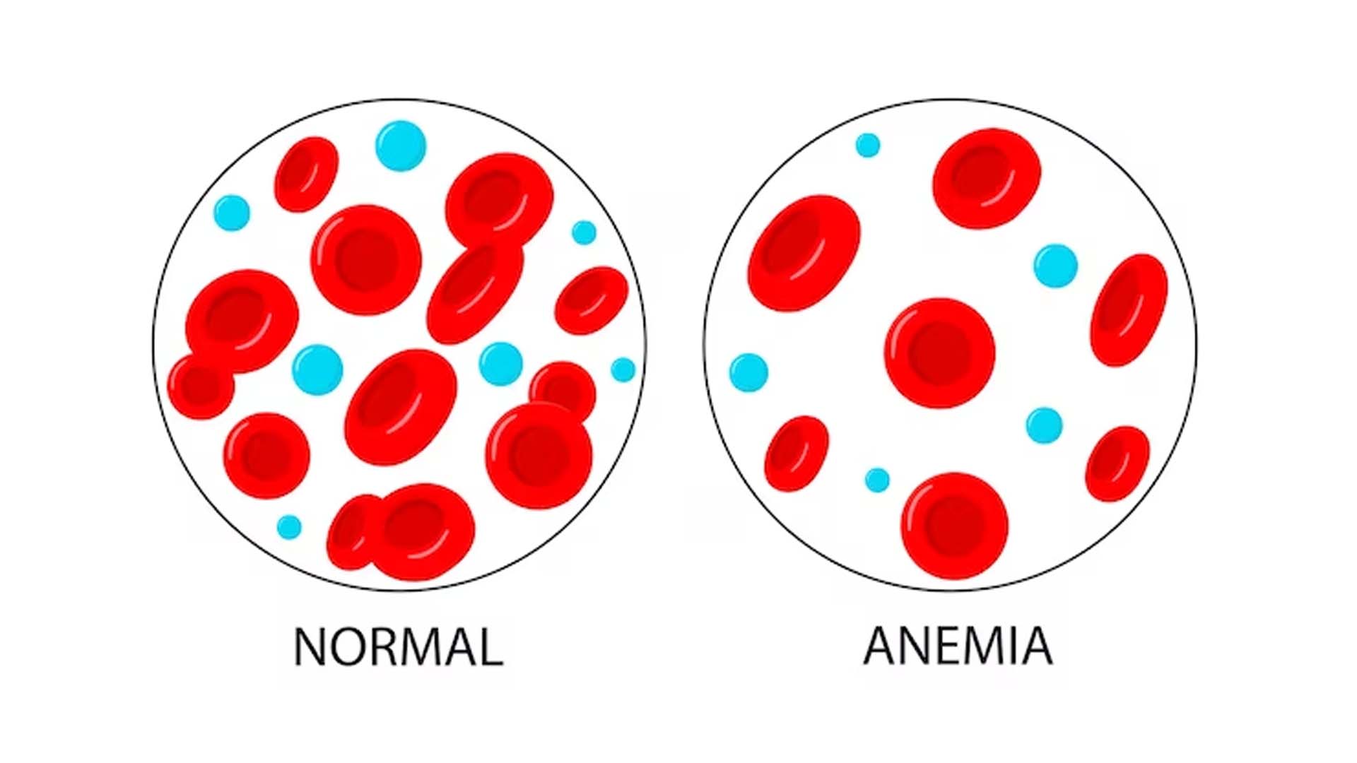 Iron Deficiency Anemia