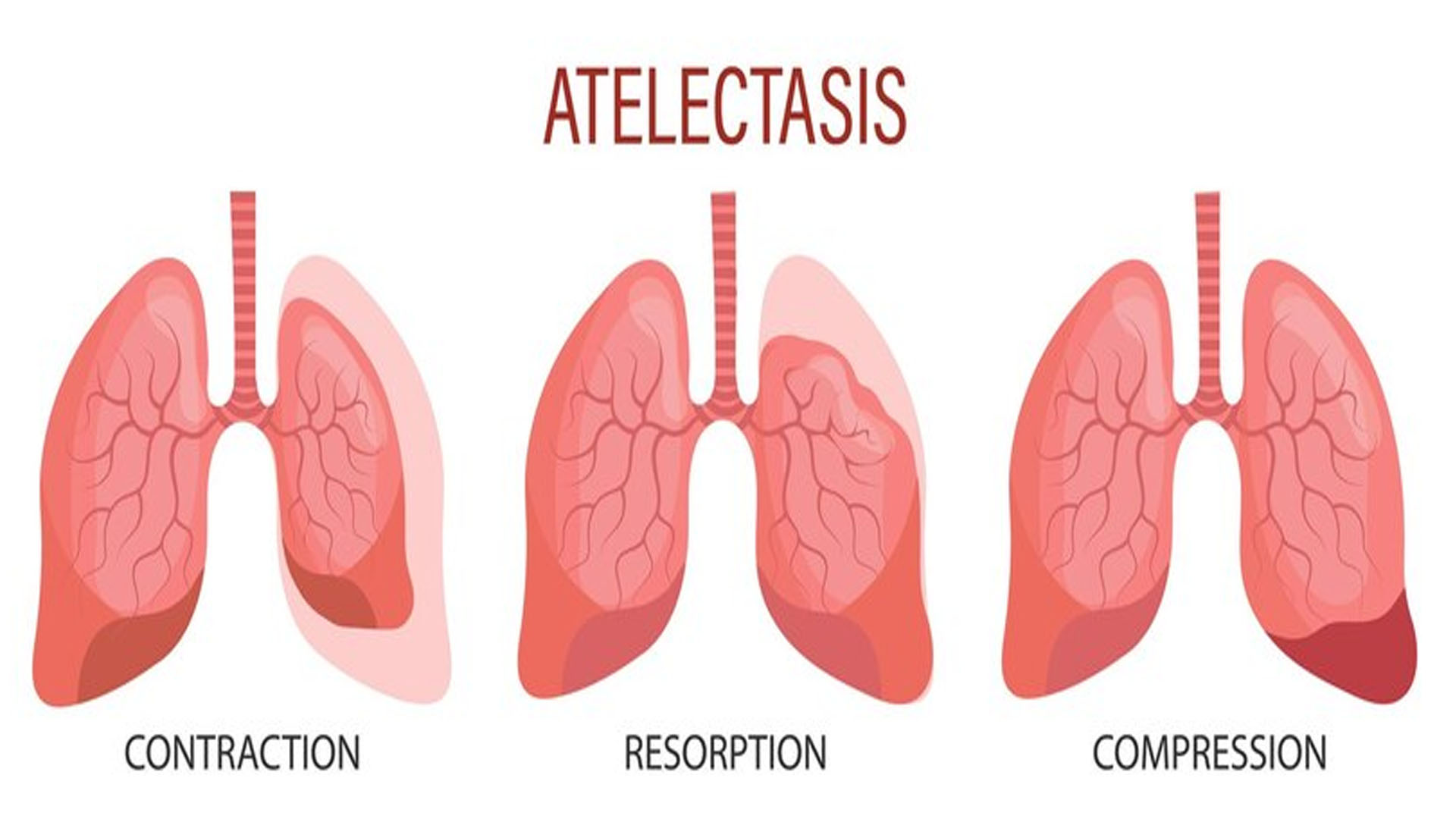 What are the Symptoms of Atelectasis?