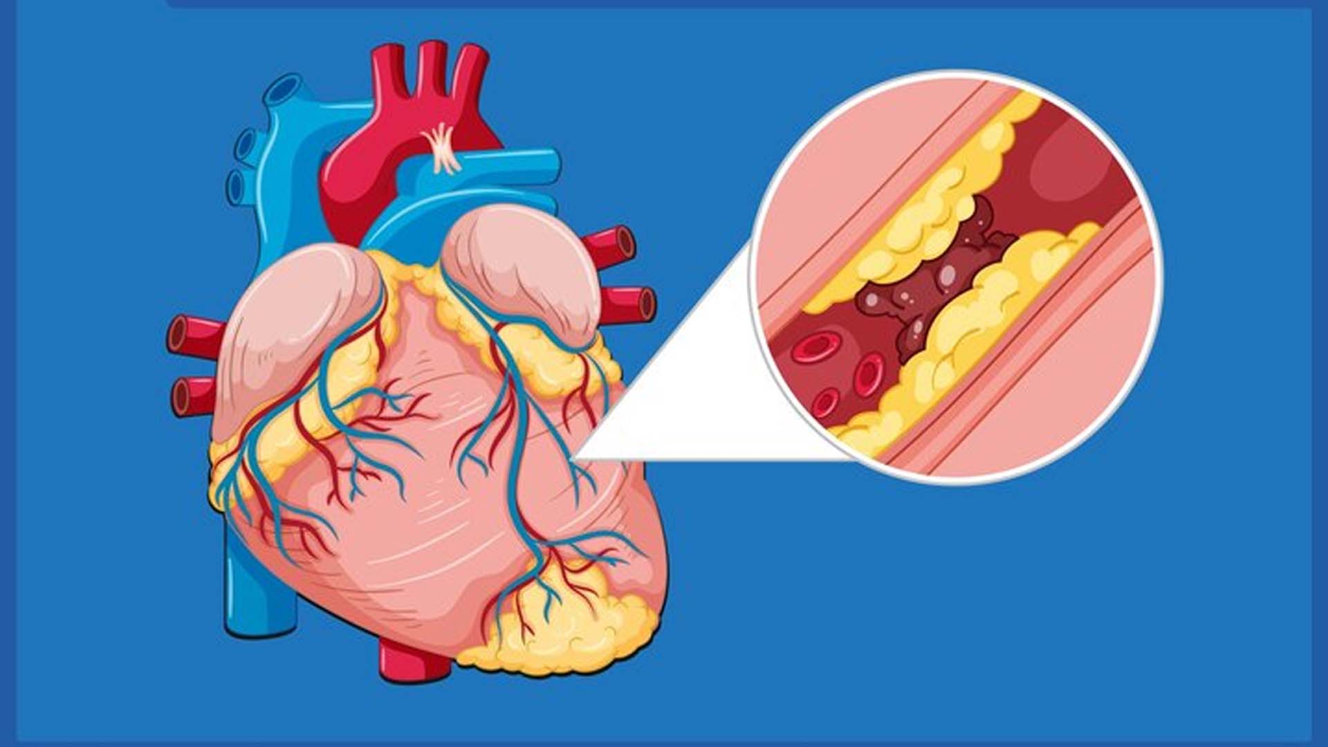 Blocked Arteries or Atherosclerosis