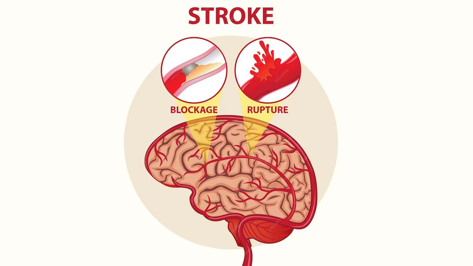 Brain Stroke Illustration