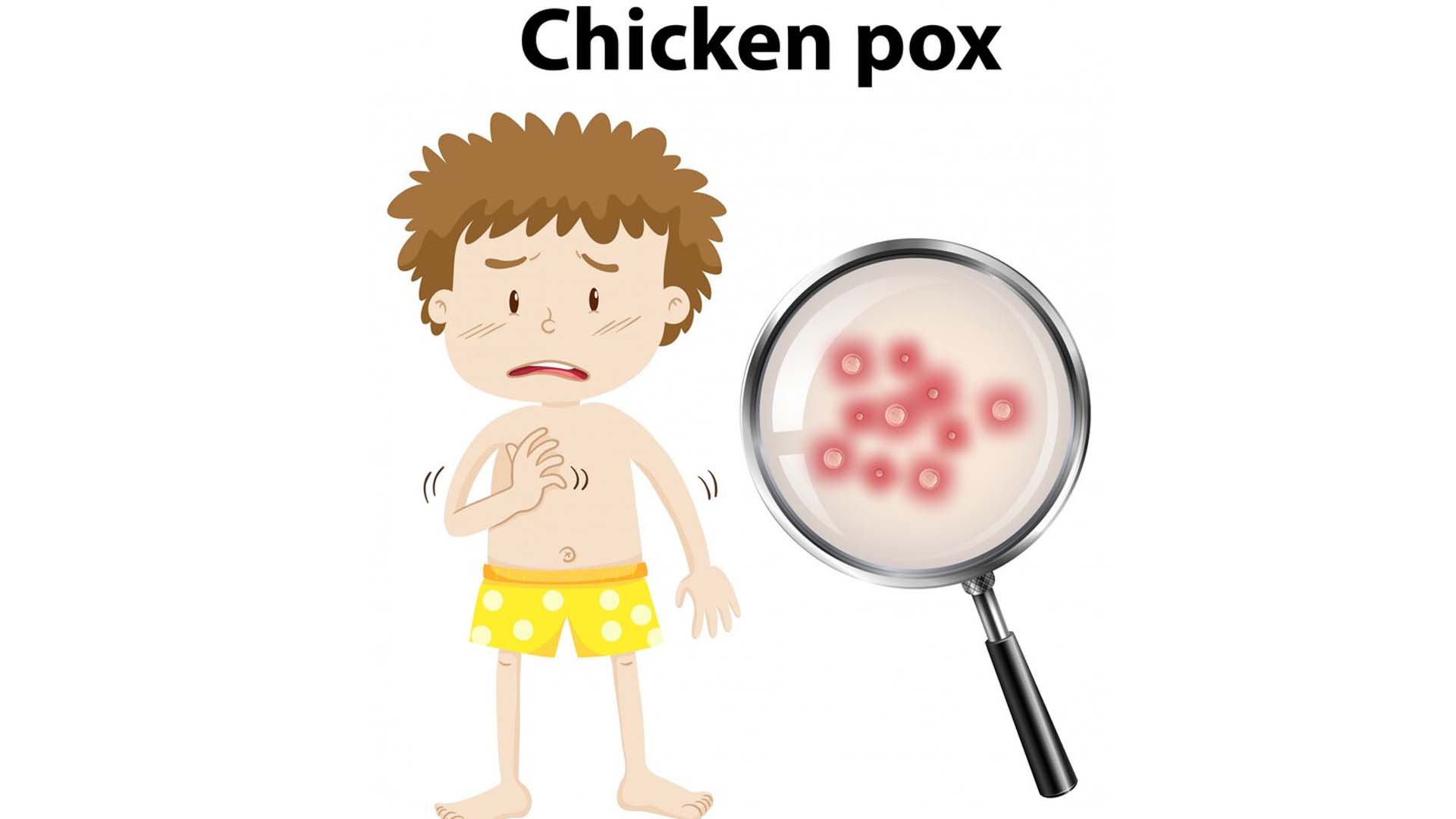 Chickenpox