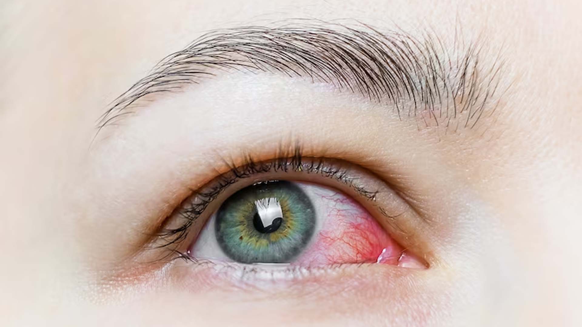 Conjunctivitis or Pink eye