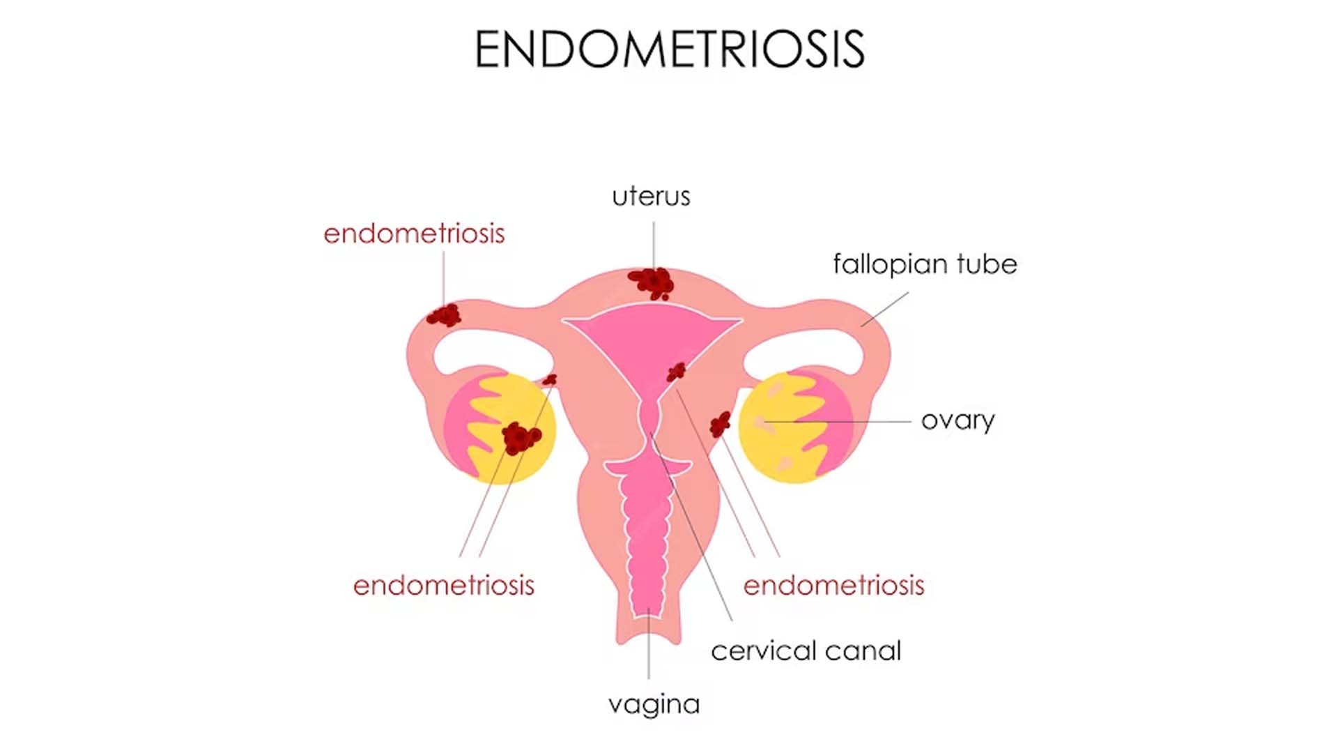 Endometriosis Cartoon Diagram