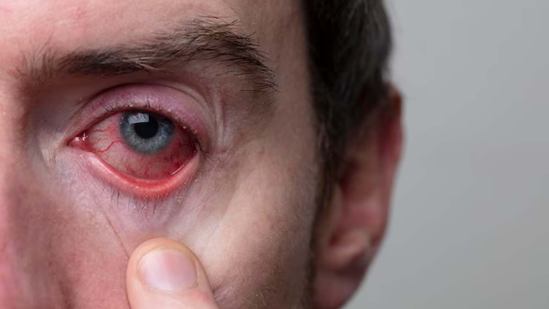 Man having Eye Infection