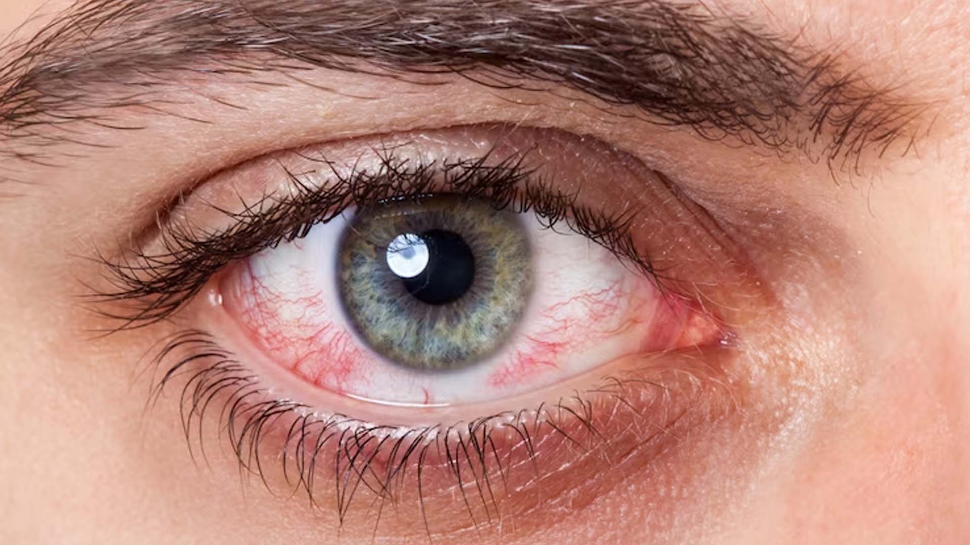 Red Eye
