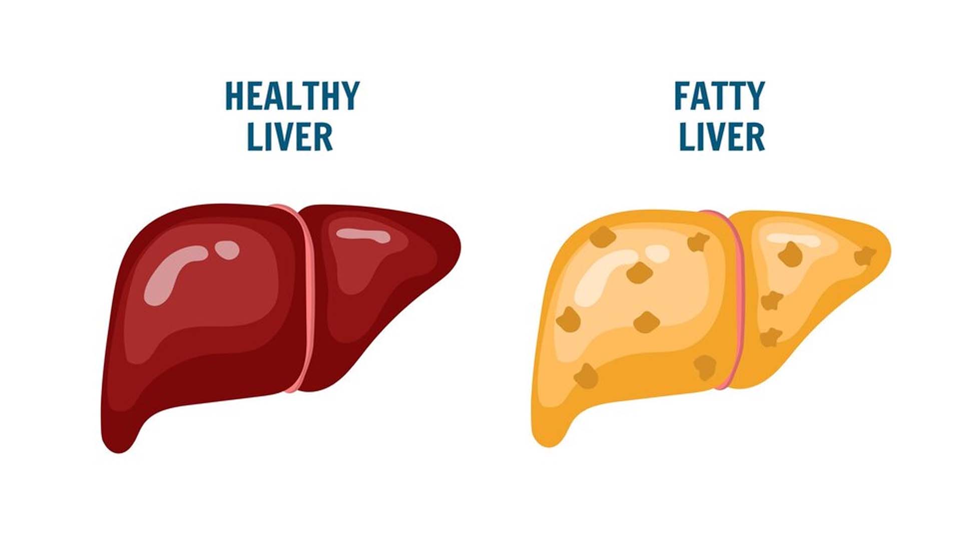 Healthy Liver and Fatty Liver