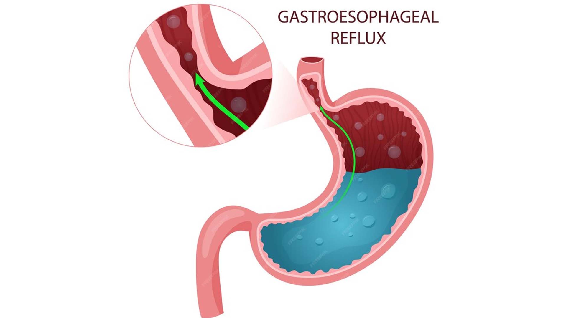 Acid reflux gastroesophageal reflux disease or GERD