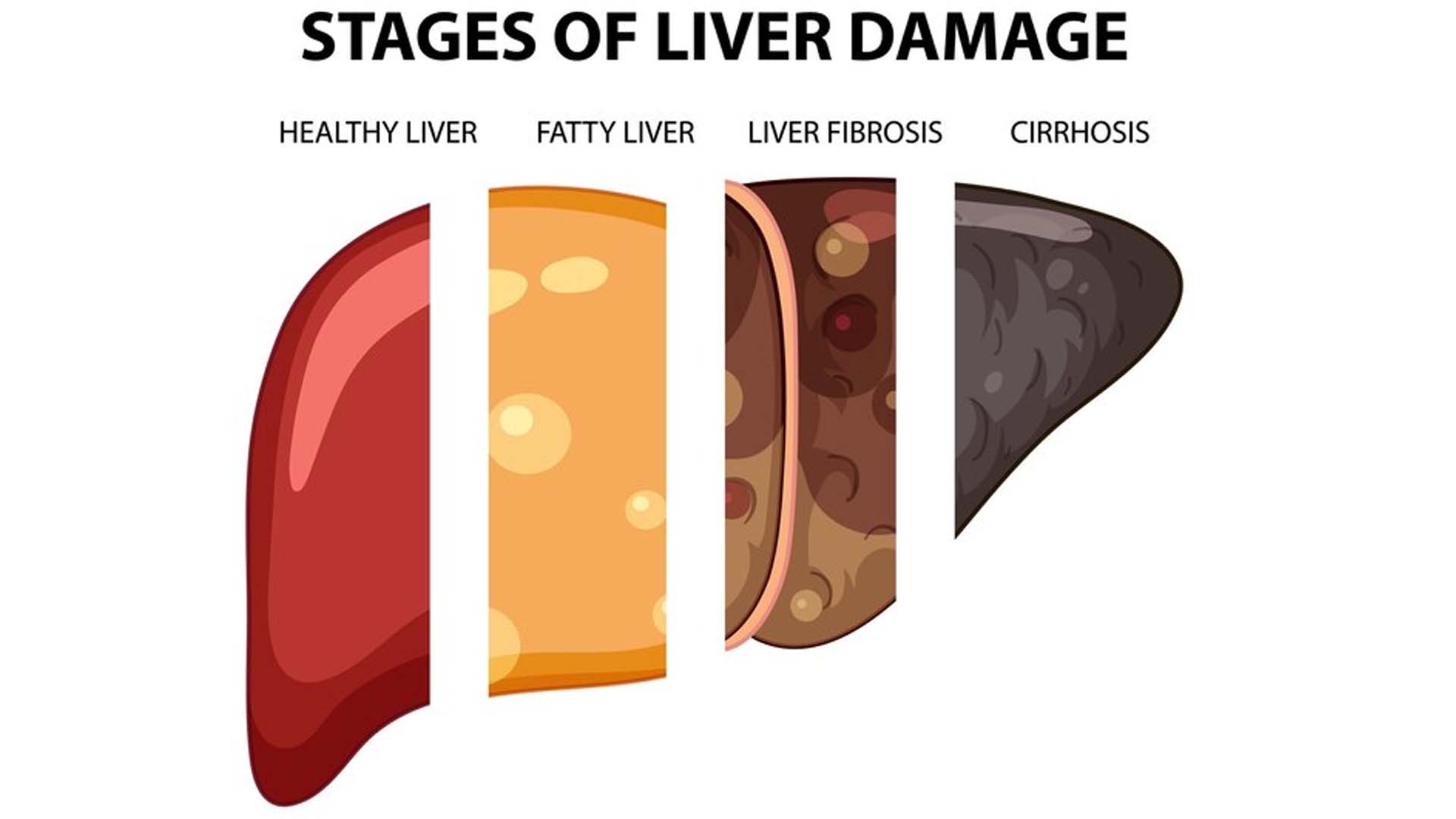 Stages of Liver Damage