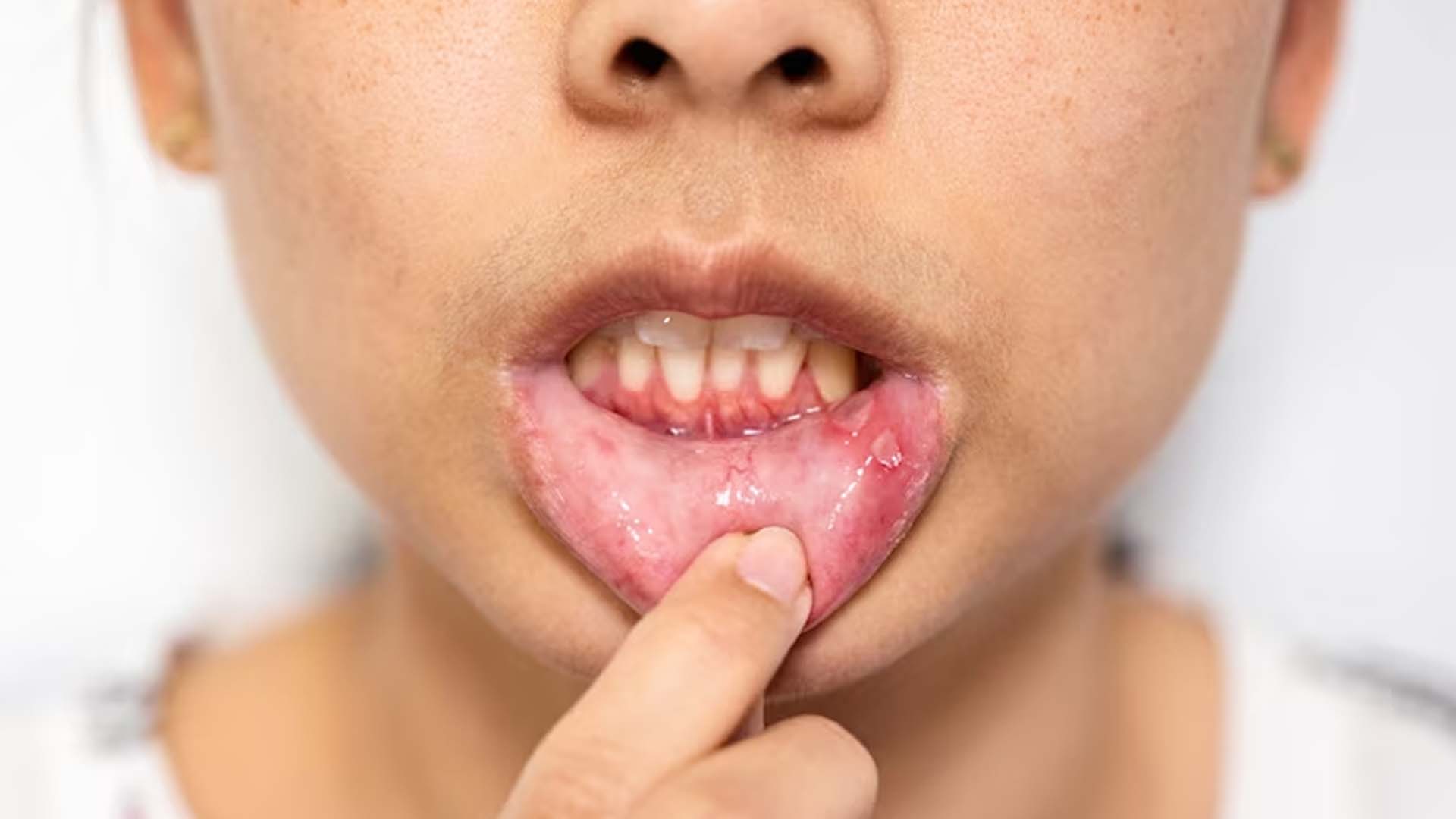 Women Showing Mouth Ulcers
