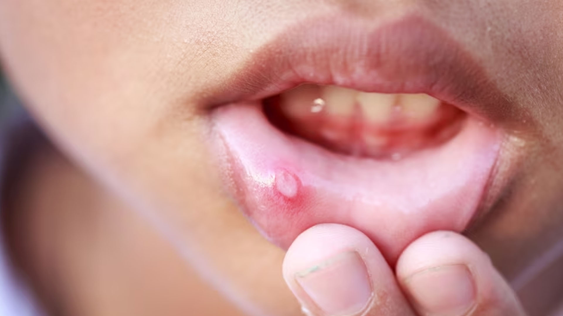 What are Mouth Ulcers a Symptom of?