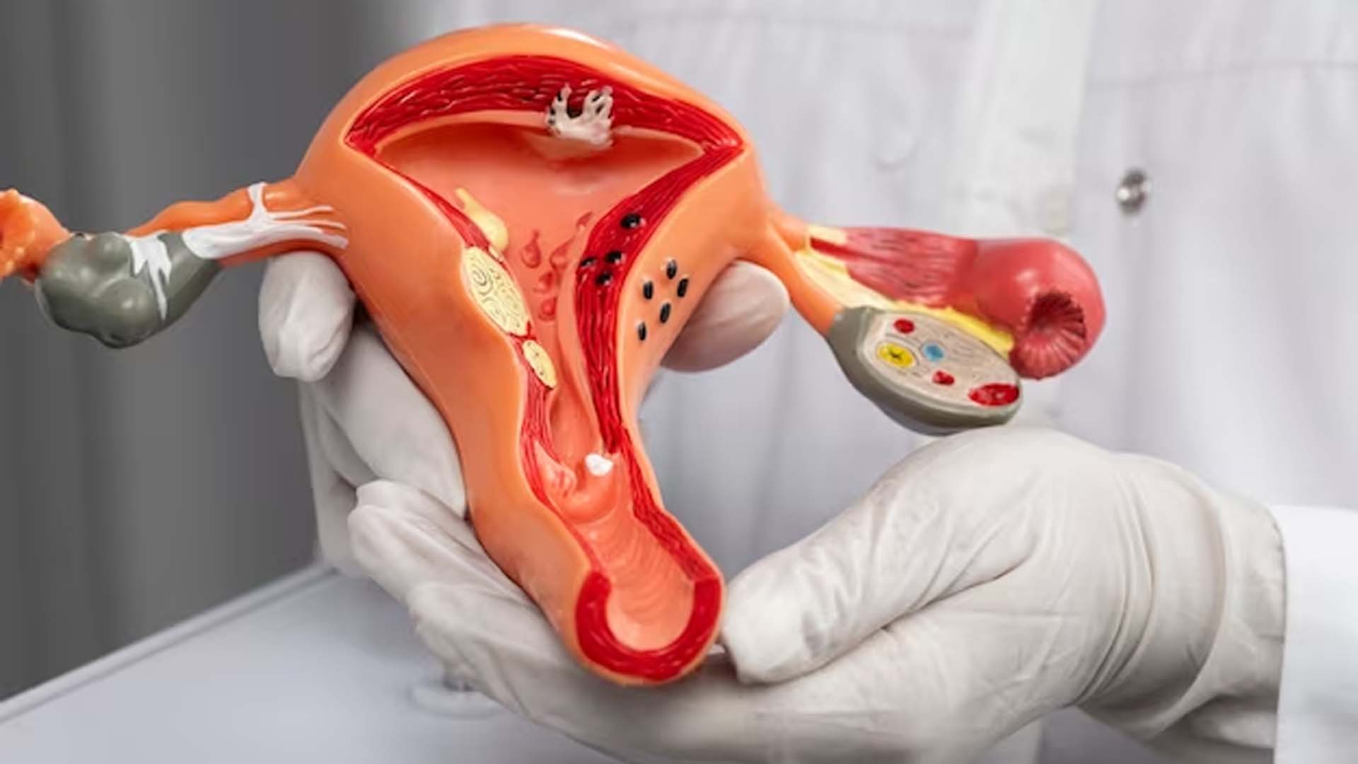 Doctor showing Uterus Model with Uterine fibroids