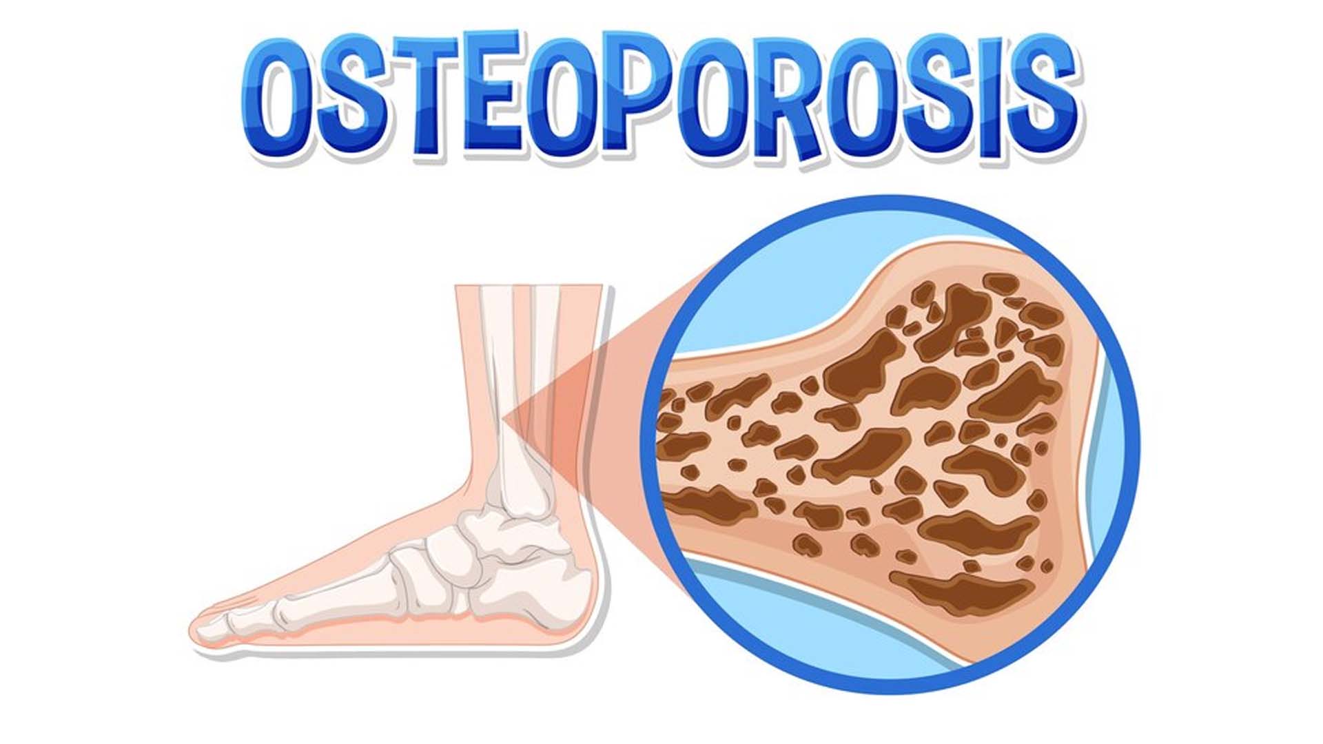 Osteoporosis