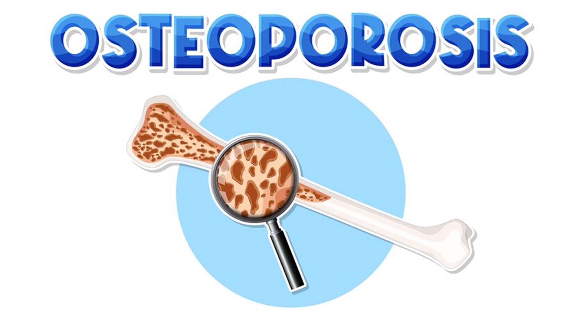 Osteoporosis Bone