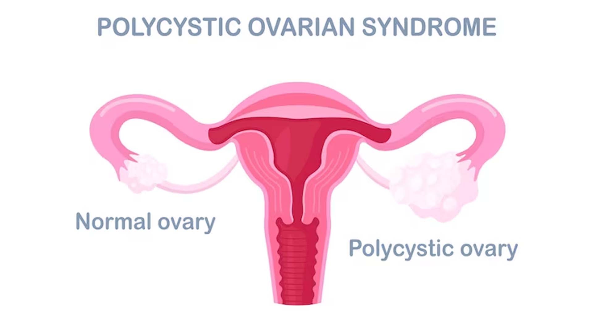 Polycystic Ovary Syndrome (PCOS)