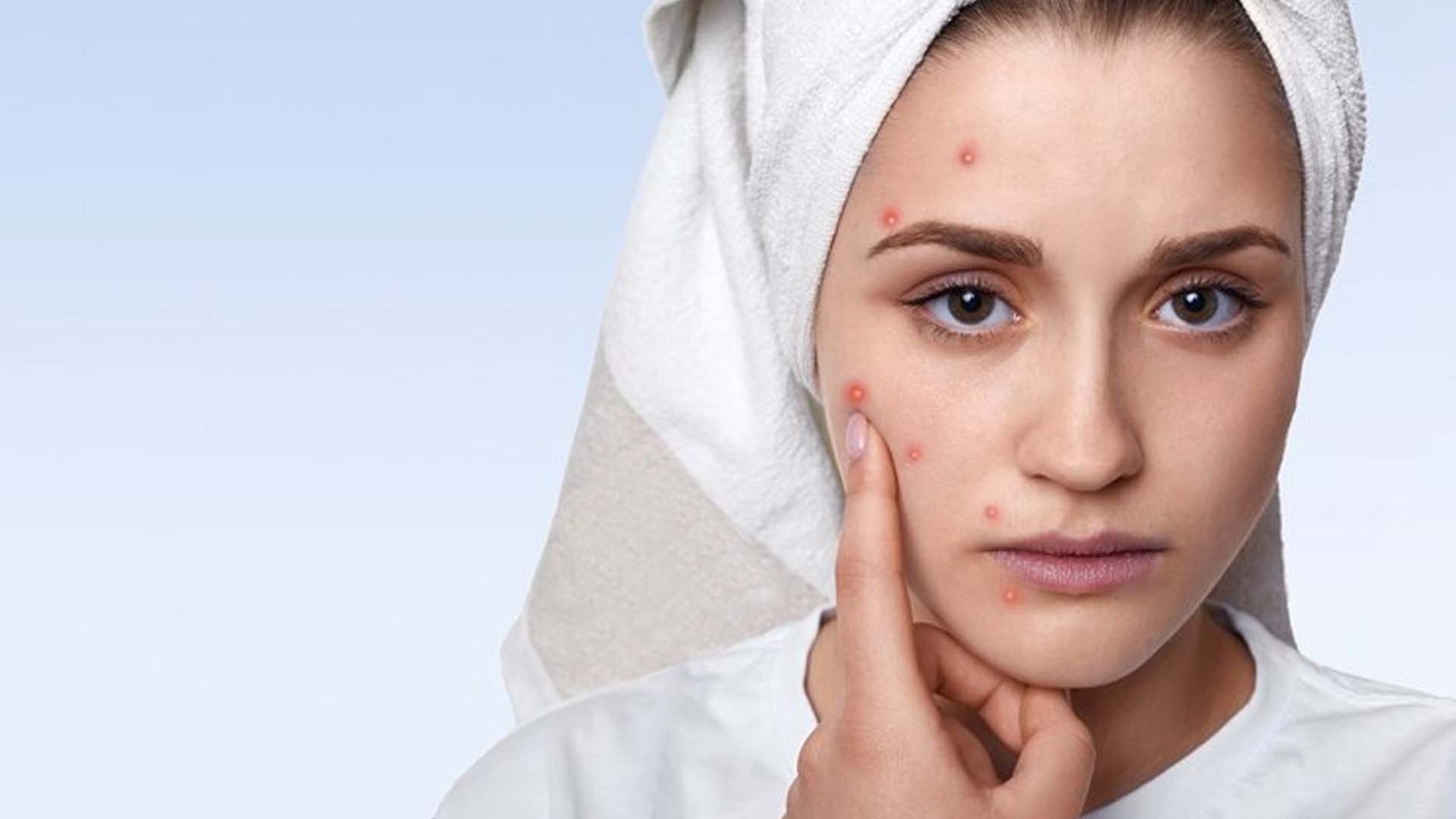 pimples on face