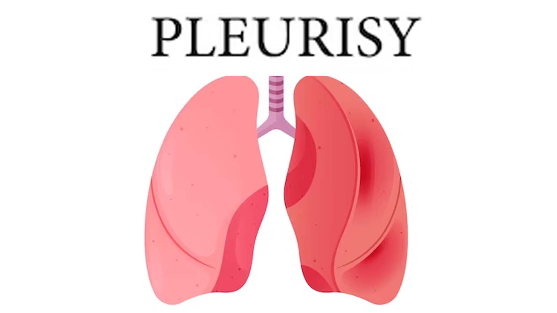 Pleurisy