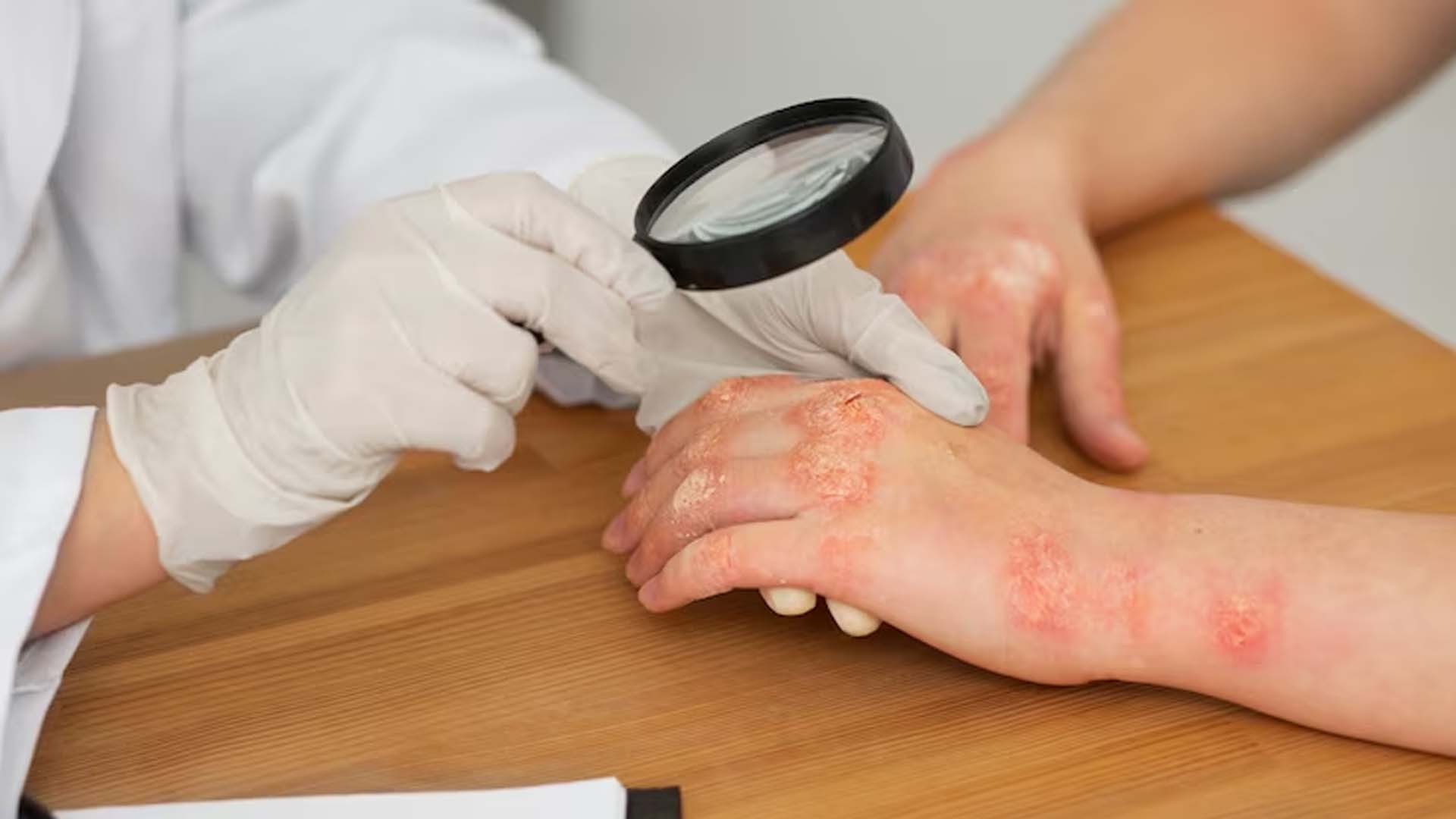 Doctor Examines Patients hand with Skin disease