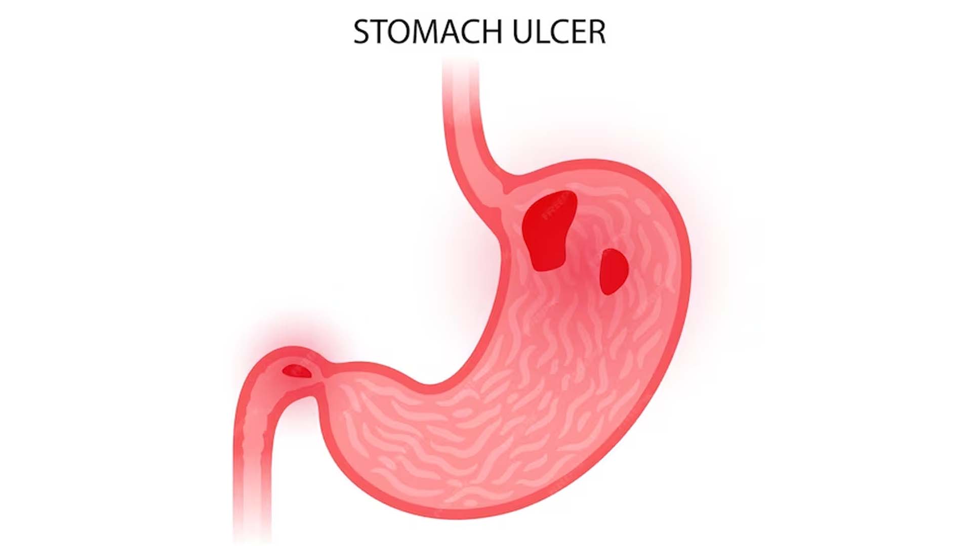 Stomach Ulcer Diagram