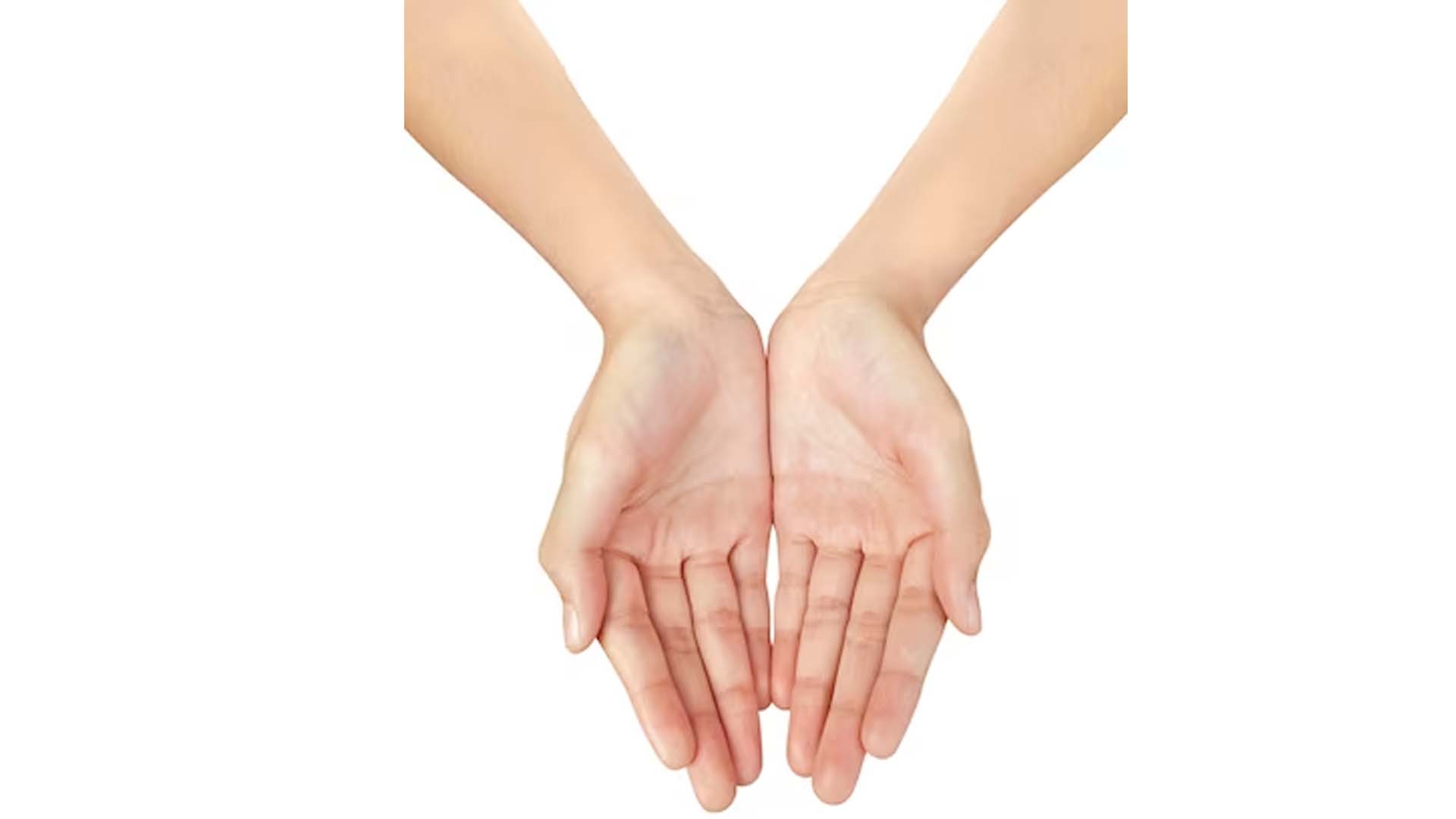 Palmar hyperhidrosis