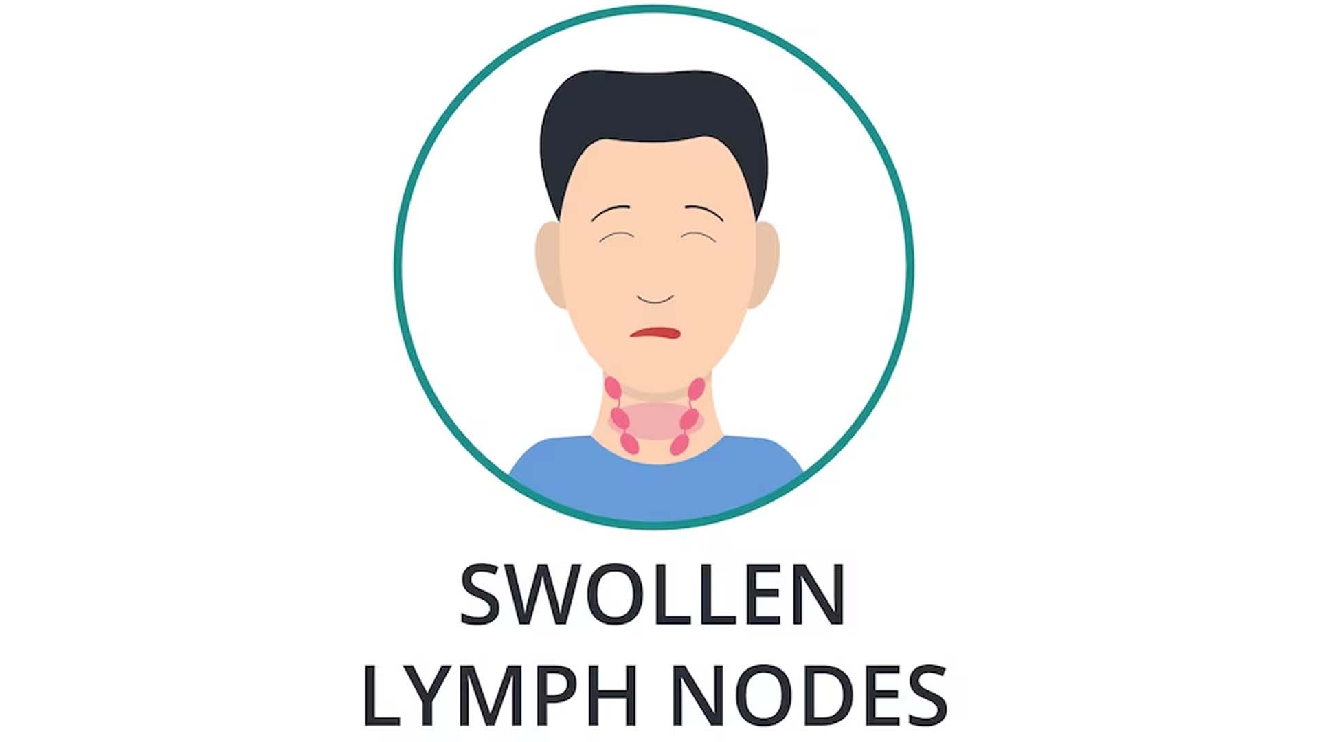 Swollen Lymph Nodes or Lymphadenopathy
