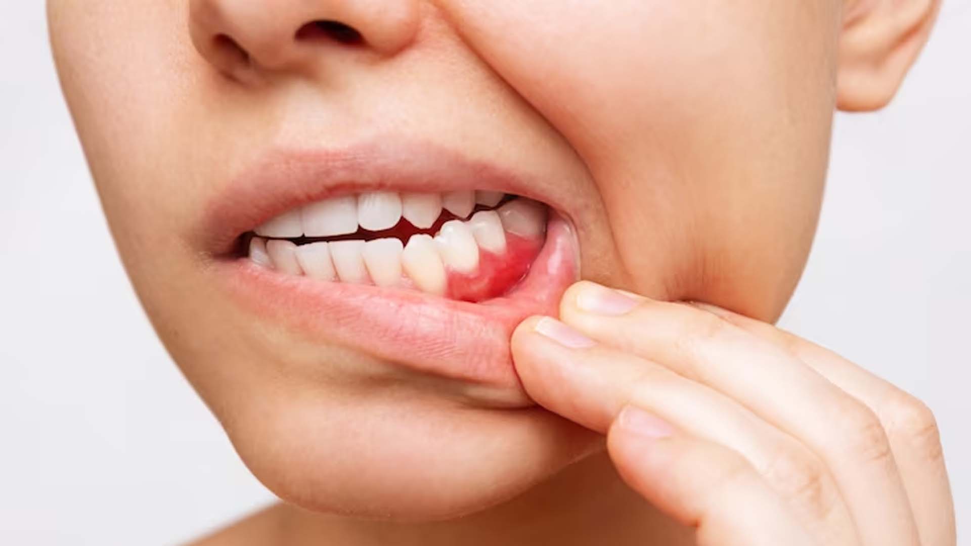 Gum swelling or gum inflammation