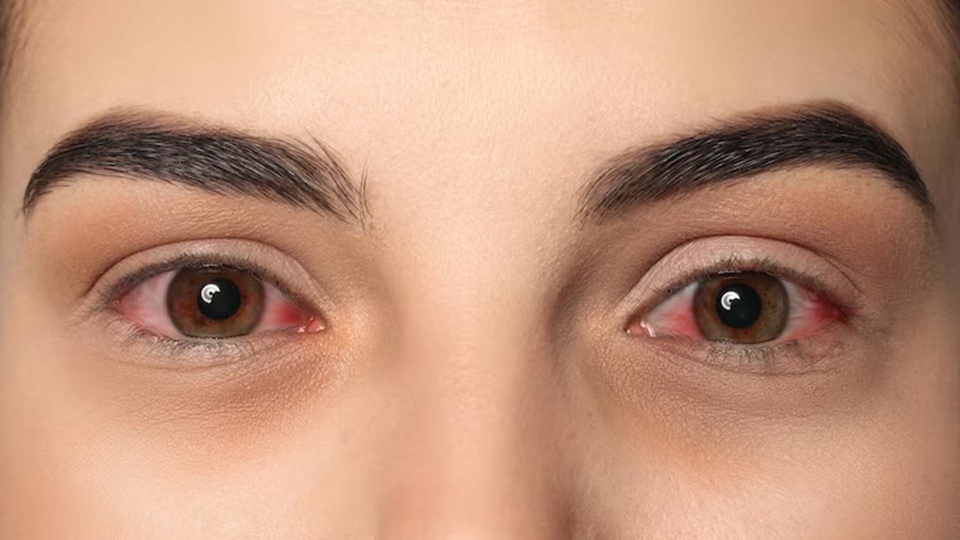 Conjunctivitis or Pink eye