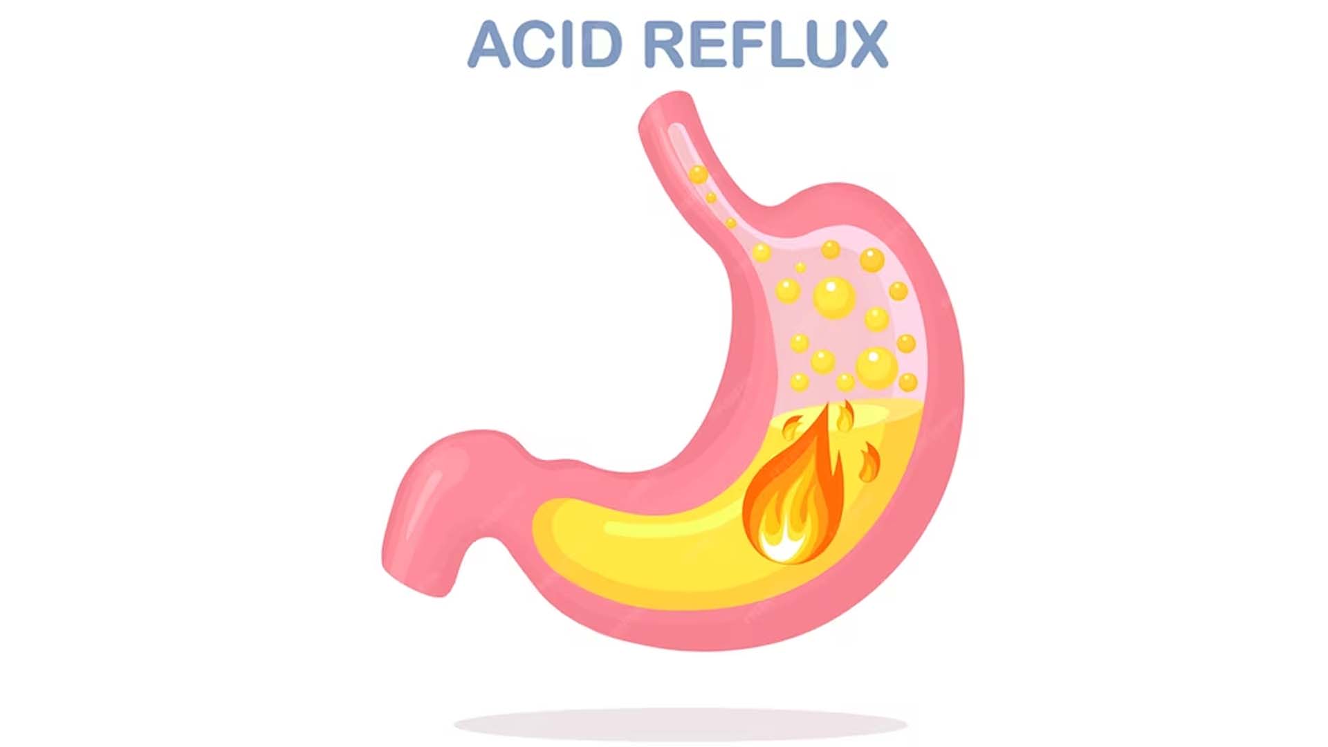 Acid Reflux