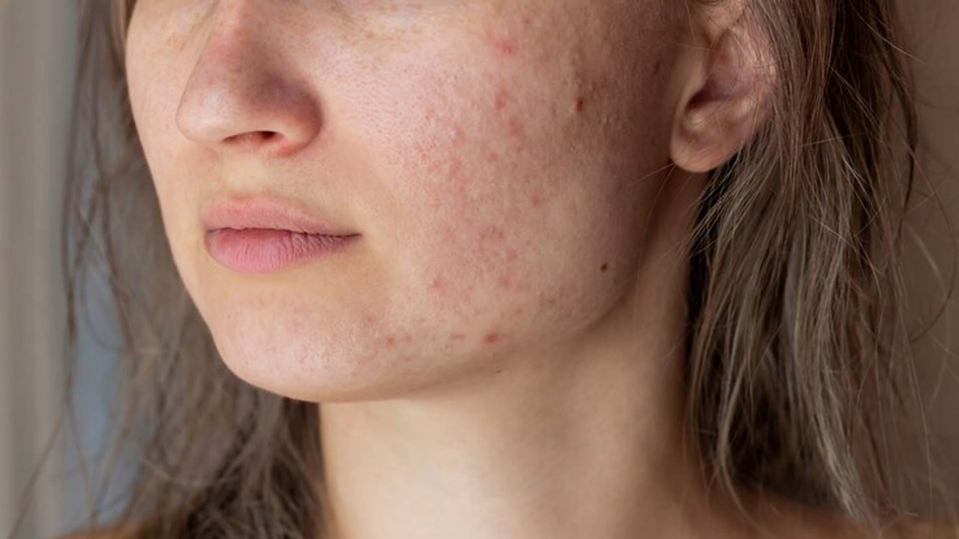 Women with Acne