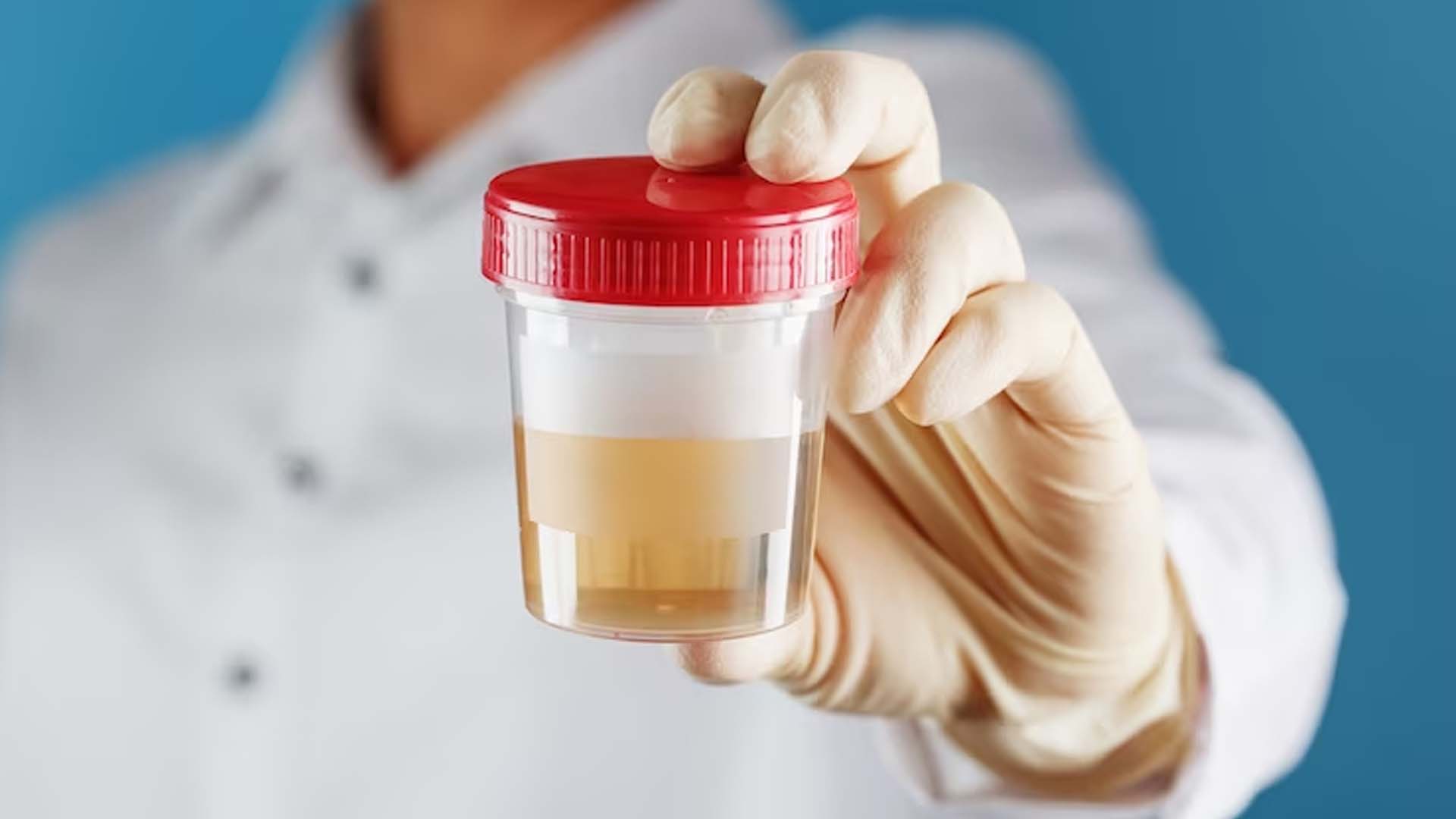 Blood in Urine
