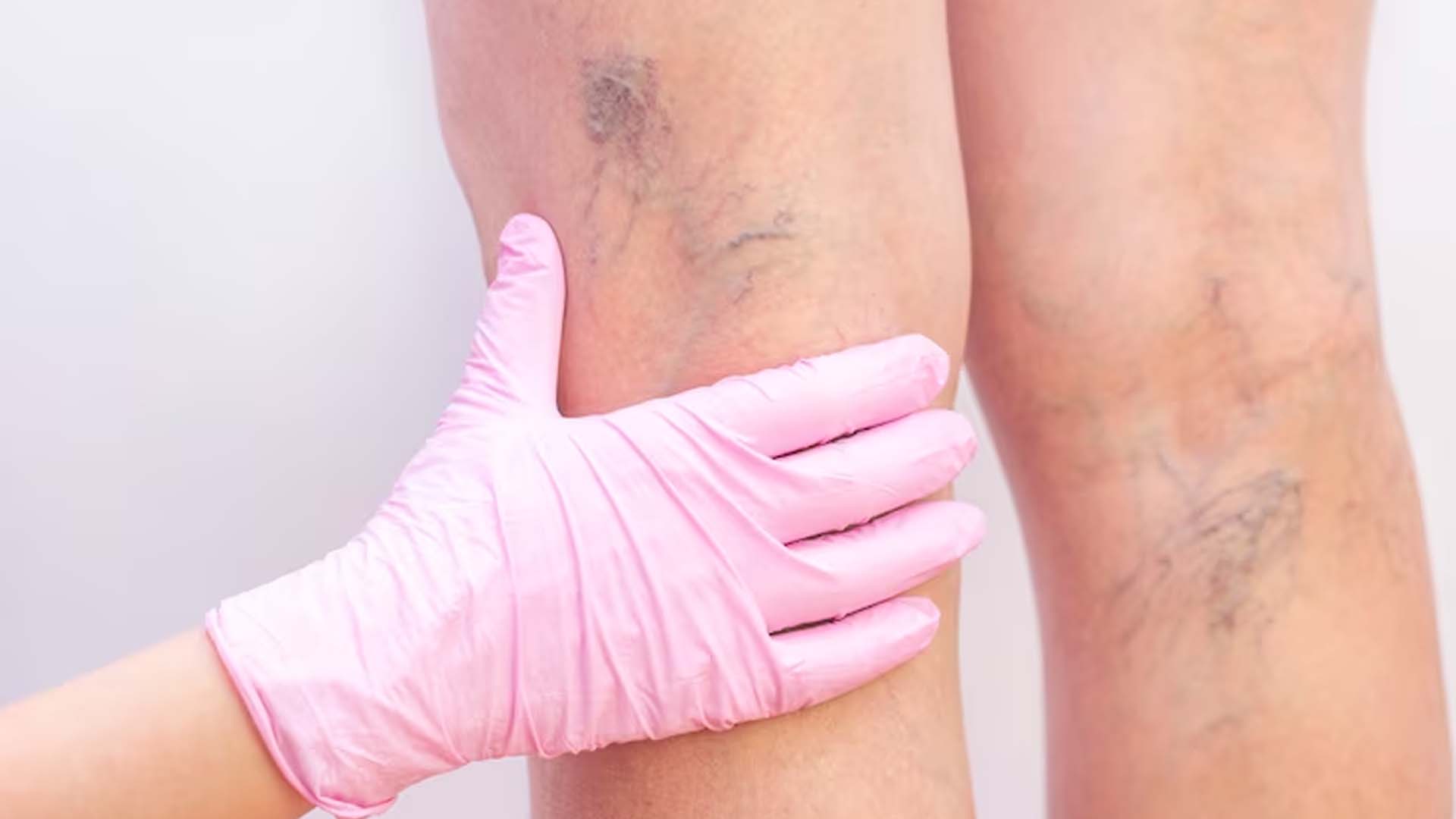 Varicose Veins in female
