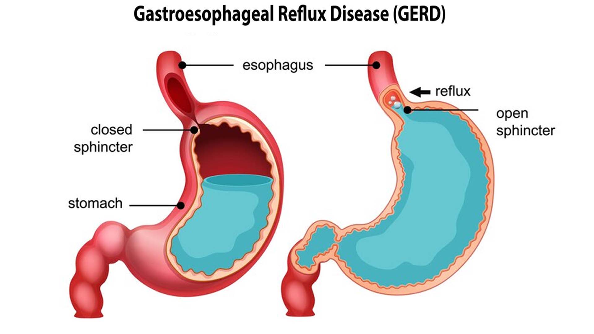 Gastroesophageal reflux disease (GERD)