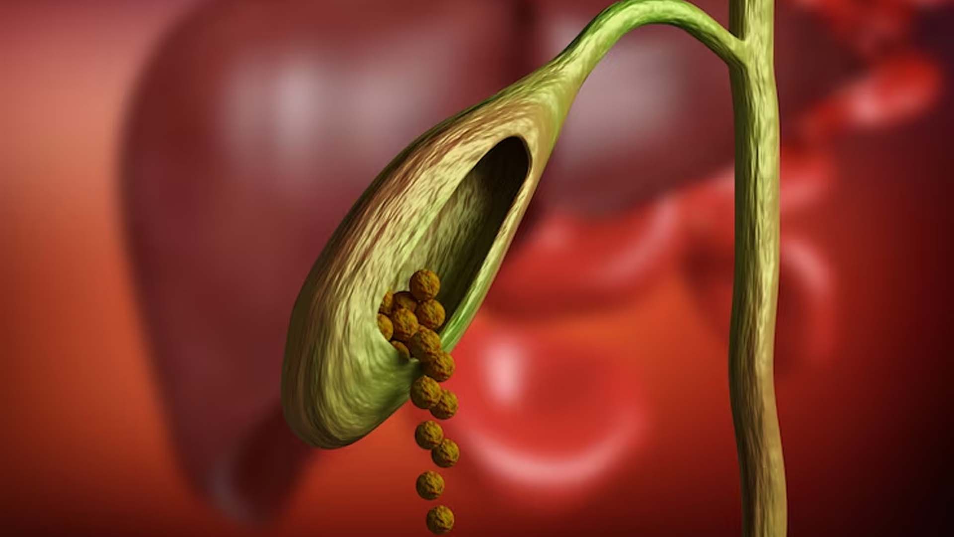 3D Gallstones image