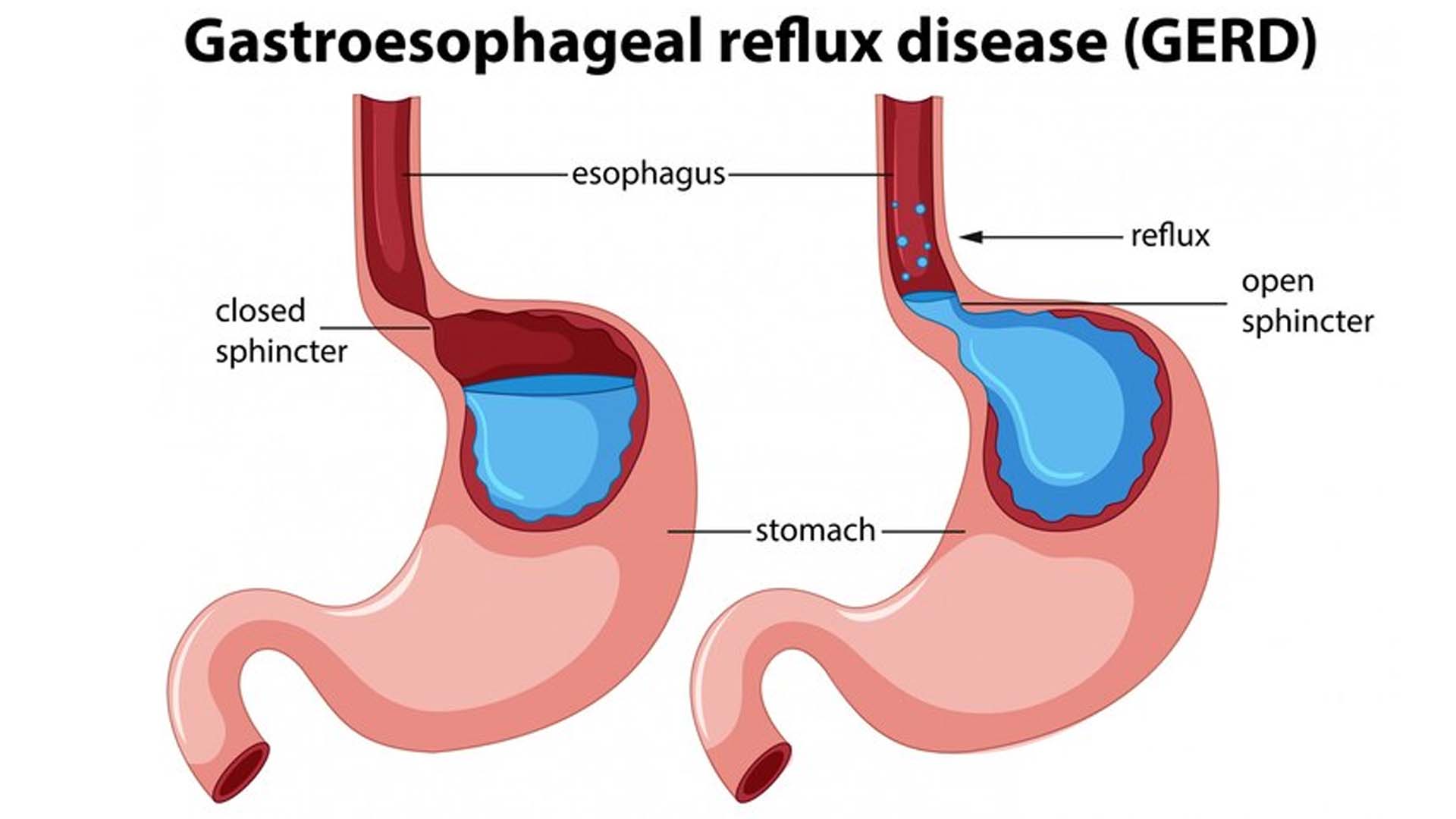 gastroesophageal reflux disease (GERD)